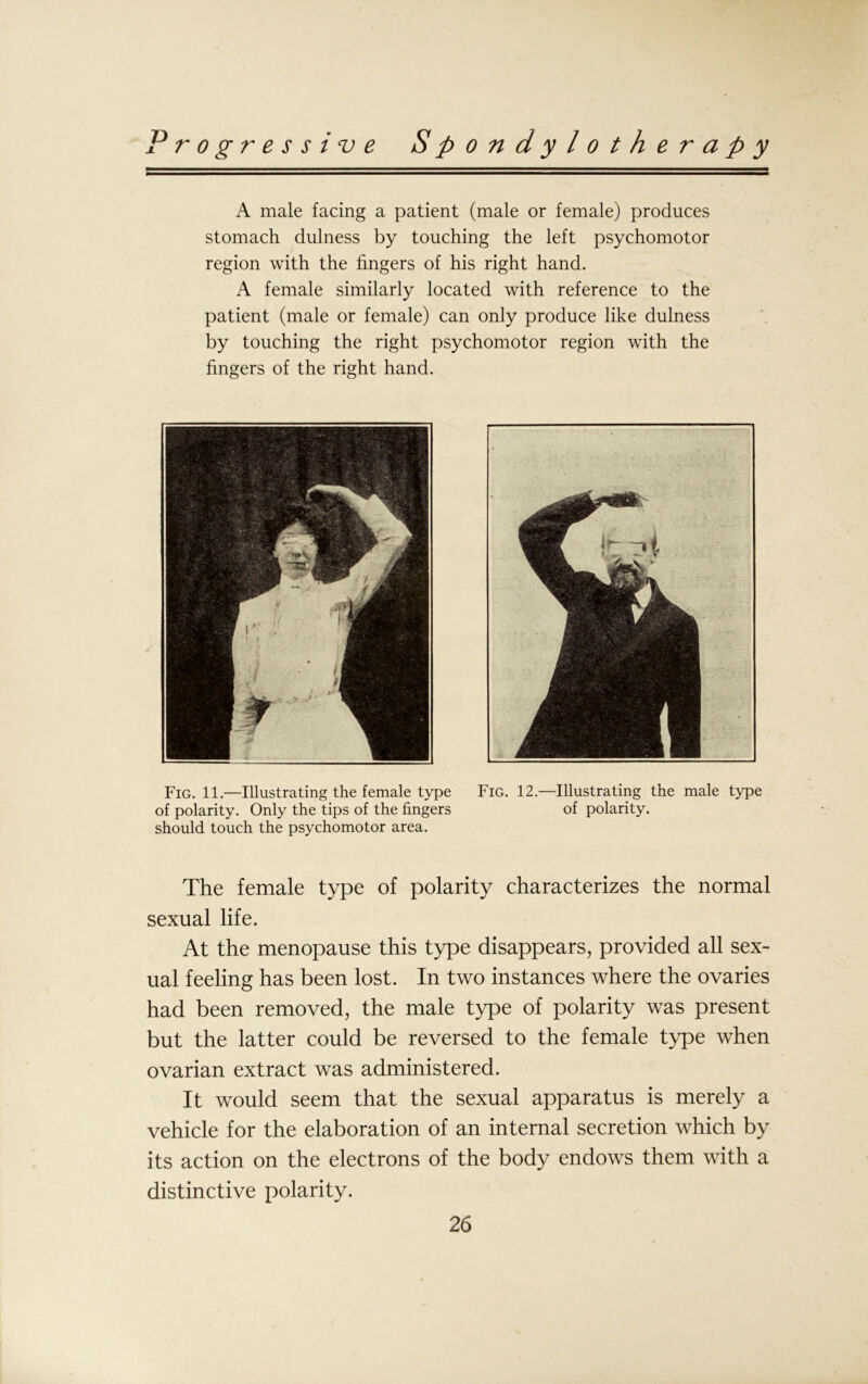 A male facing a patient (male or female) produces stomach dulness by touching the left psychomotor region with the fingers of his right hand. A female similarly located with reference to the patient (male or female) can only produce like dulness by touching the right psychomotor region with the fingers of the right hand. Fig. 11.—Illustrating the female type Fig. 12.—Illustrating the male type of polarity. Only the tips of the fingers of polarity, should touch the psychomotor area. The female type of polarity characterizes the normal sexual life. At the menopause this type disappears, provided all sex- ual feeling has been lost. In two instances where the ovaries had been removed, the male type of polarity was present but the latter could be reversed to the female type when ovarian extract was administered. It would seem that the sexual apparatus is merely a vehicle for the elaboration of an internal secretion which by its action on the electrons of the body endows them with a distinctive polarity.