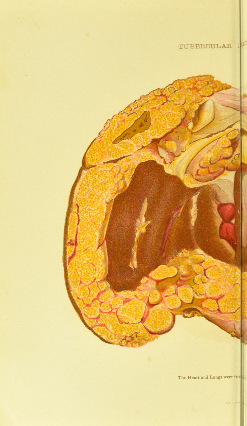 tubercular The Heart and Lungs were fro 4