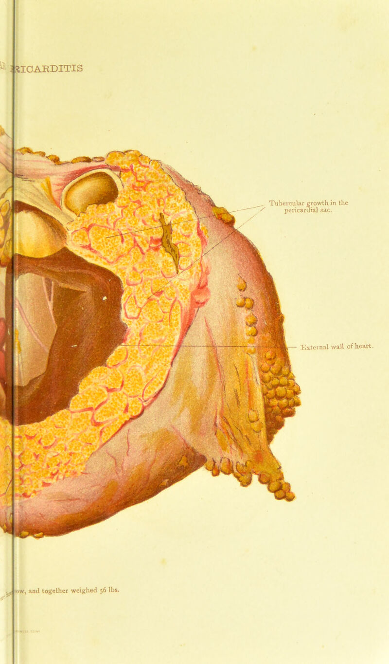 IICARDITIS External wall of heart. ow, and together weighed 56 lbs. Tubercular growth in the pericardial sac.