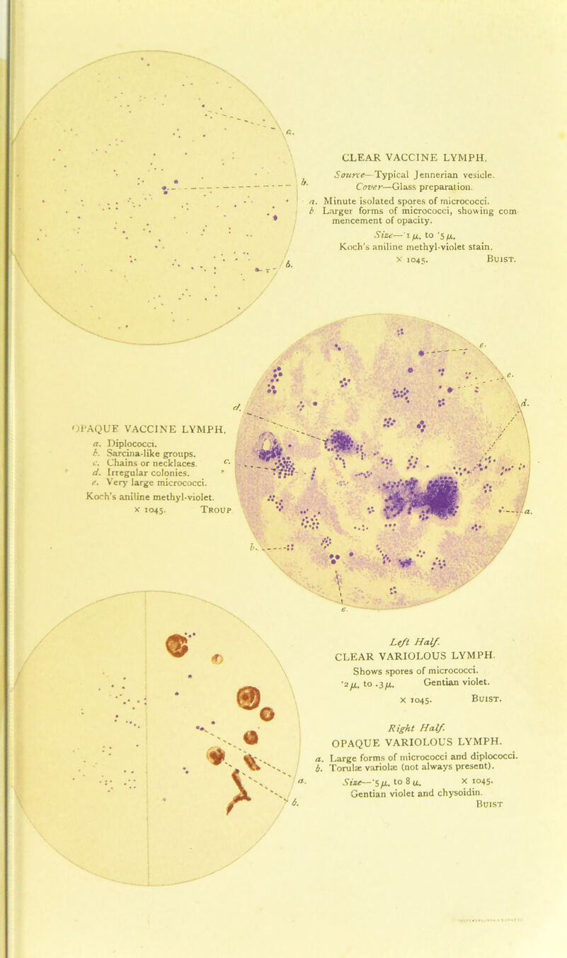 CLEAR VACCINE LYMPH. Source—Typical Jennerian vesicle. Cover—Glass preparat ion. Minute isolated spores of micrococci. Larger forms of micrococci, showing com mencement of opacity. Size—Hi, to '5//.. Koch’s aniline methyl-violet stain. x 1045. Buist. OPAQUE VACCINE LYMPH. a. Diplococci. b. Sarcina-like groups. c. Chains or necklaces. c- d. Irregular colonies. * [ e. Very large micrococci. — • ;t.t - xp • • •JV Koch’s aniline methyl-violet. •v... x 1045. Troup . e Left Half CLEAR VARIOLOUS LYMPH. Shows spores of micrococci. ■2/4. to .3/4. Gentian violet. x 1045. Buist. Right Half OPAQUE VARIOLOUS LYMPH. a. Large forms of micrococci and diplococci. b. Torulae variola: (not always present). Size—'5 fj,. to 8 u. * io45- Gentian violet and chysoidin. Buist