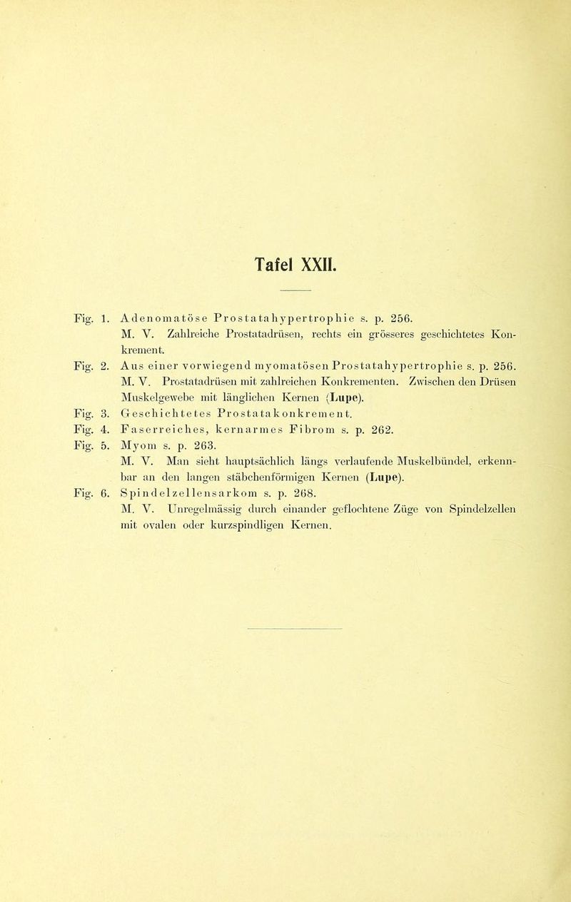 Fig. 1 Fig. 2 Fig. 3 Fig. 4 Fig. 5 Fig. 6 Adenomatöse Prostatahypertrophie s. p. 256. M. Y. Zahlreiche Prostatadrüsen, rechts ein grösseres geschichtetes Kon- krement. Aus einer vorwiegend myomatösen Prostatahypertrophie s. p. 256. M. V. Prostatadrüsen mit zahlreichen Konkrementen. Zwischen den Drüsen Muskelgewebe mit länglichen Kernen (Lupe). Geschichtetes Prostatakonkrement. Faserreiches, kernarmes Fibrom s. p. 262. Myom s. p. 263. M. Y. Man sieht hauptsächlich längs verlaufende Muskelbündel, erkenn- bar an den langen stäbchenförmigen Kernen (Lupe). Spindelzellensarkom s. p. 268. M. V. Unregelmässig durch einander geflochtene Züge von Spindelzellen mit ovalen oder kurzspindligen Kernen.