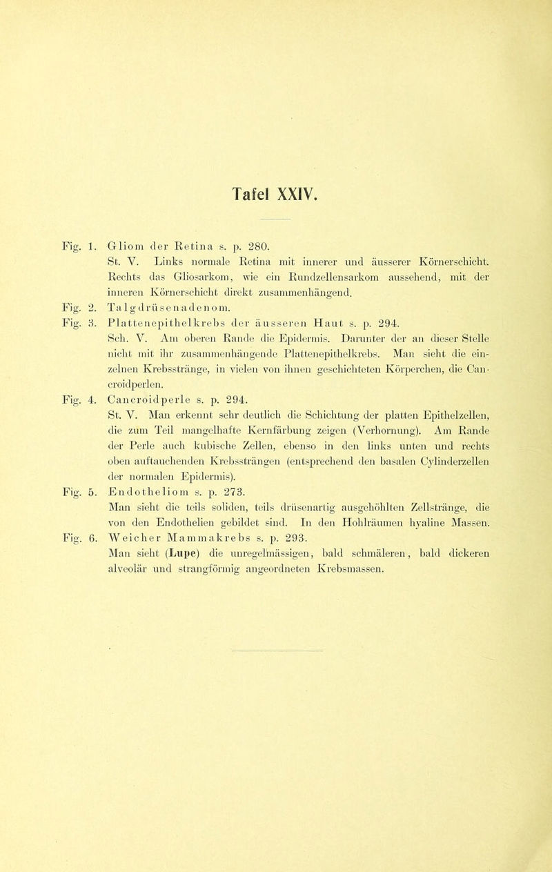 Fig. 2 Fig. 3 Fig. 4 Fig. 5 Fig. 6 Tafel XXIV. St. V. Links normale Retina mit innerer und äusserer Körnerschicht. Rechts das Gliosarkom, wie ein Rundzellensarkom aussehend, mit der inneren Körnerschicht direkt zusammenhängend. . Talgdrüsenadenom. . Plattenepithel krebs der äusseren Haut s. p. 294. Sch. V. Am oberen Rande die Epidermis. Darunter der an dieser Stelle nicht mit ihr zusammenhängende Plattenepithelkrebs. Man sieht die ein- zelnen Krebsstränge, in vielen von ihnen geschichteten Körperchen, die Can- croidperlen. . Cancroidperle s. p. 294. St. Y. Man erkennt sehr deutlich die Schichtung der platten Epithelzellen, die zum Teil mangelhafte Kernfärbung zeigen (Verhornung). Am Rande der Perle auch kubische Zellen, ebenso in den links unten und rechts oben auftauchenden Krebssträngen (entsprechend den basalen Cylinderzellen der normalen Epidermis). . Endotheliom s. p. 273. Man sieht die teils soliden, teils drüsenartig ausgehöhlten Zellstränge, die von den Endothelien gebildet sind. In den Hohlräumen hyaline Massen. . Weicher Mammakrebs s. p. 293. Man sieht (Lupe) die unregelmässigen, bald schmäleren, bald dickeren alveolär und strangförmig angeordneten Krebsmassen.