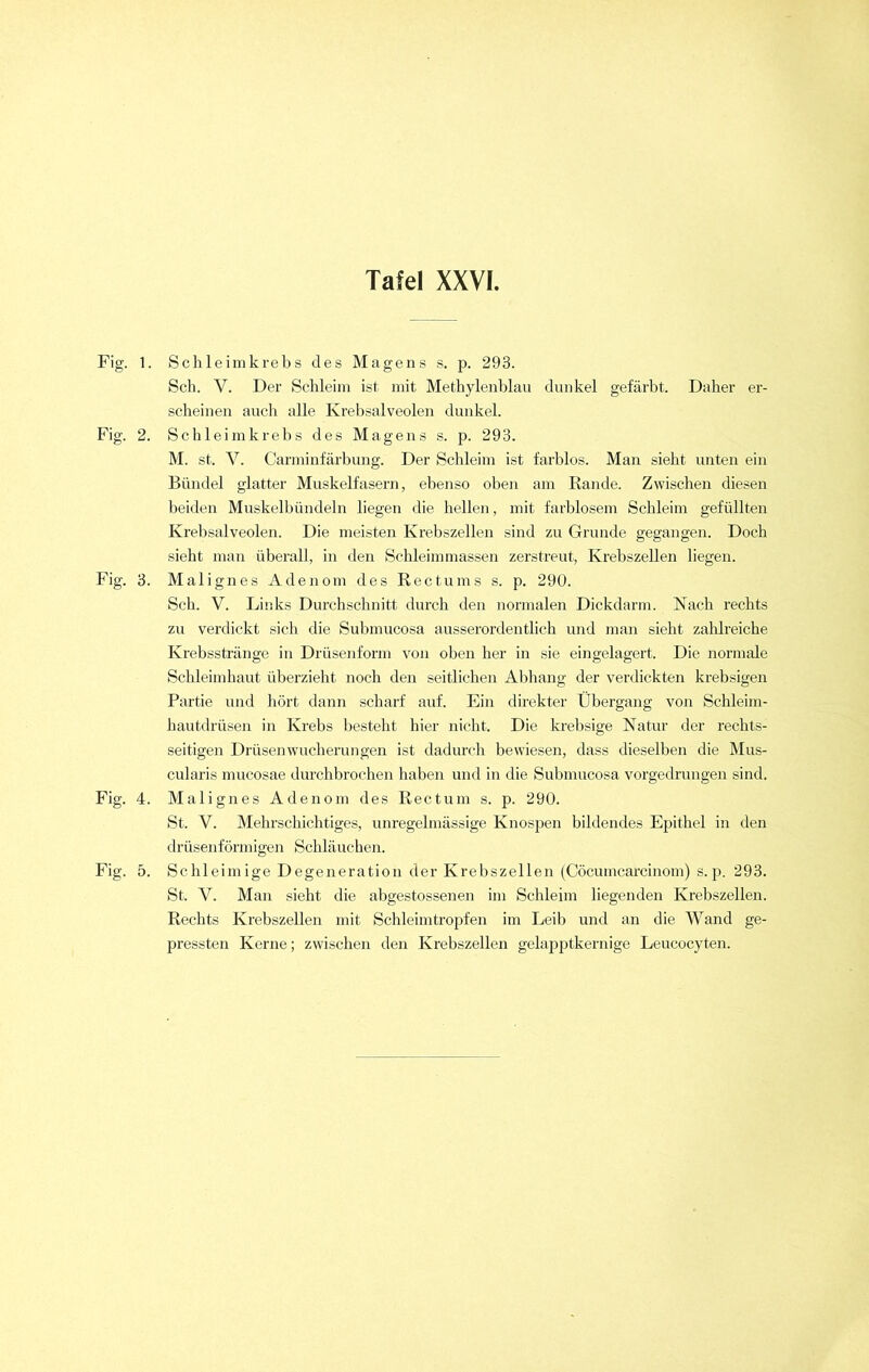 Fig. 1 Fig. 2 Fig. 3 Fig. 4 Fig. 5 . Schleimkrebs des Magens s. p. 293. Sch. Y. Der Schleim ist mit Methylenblau dunkel gefärbt. Daher er- scheinen auch alle Krebsalveolen dunkel. . Schleimkrebs des Magens s. p. 293. M. st. V. Carminfärbung. Der Schleim ist farblos. Man sieht unten ein Bündel glatter Muskelfasern, ebenso oben am Rande. Zwischen diesen beiden Muskelbündeln liegen die hellen, mit farblosem Schleim gefüllten Krebsalveolen. Die meisten Krebszellen sind zu Grunde gegangen. Doch sieht man überall, in den Schleimmassen zerstreut, Krebszellen liegen. . Malignes Adenom des Rectums s. p. 290. Sch. V. Links Durchschnitt durch den normalen Dickdarm. Nach rechts zu verdickt sich die Submucosa ausserordentlich und man sieht zahlreiche Krebsstränge in Drüsenform von oben her in sie eingelagert. Die normale Schleimhaut überzieht noch den seitlichen Abhang der verdickten krebsigen Partie und hört dann scharf auf. Ein direkter Übergang von Schleim- hautdrüsen in Krebs besteht hier nicht. Die krebsige Natur der rechts- seitigen Drüsenwucherungen ist dadurch bewiesen, dass dieselben die Mus- cularis mucosae durchbrochen haben und in die Submucosa vorgedrungen sind. . Malignes Adenom des Rectum s. p. 290. St. Y. Mehrschichtiges, unregelmässige Knospen bildendes Epithel in den drüsenförmigen Schläuchen. . Schleimige Degeneration der Krebszellen (Cöcumcarcinom) s. p. 293. St. V. Man sieht die abgestossenen im Schleim liegenden Krebszellen. Rechts Krebszellen mit Schleimtropfen im Leib und an die Wand ge- pressten Kerne; zwischen den Krebszellen gelapptkernige Leucocyten.