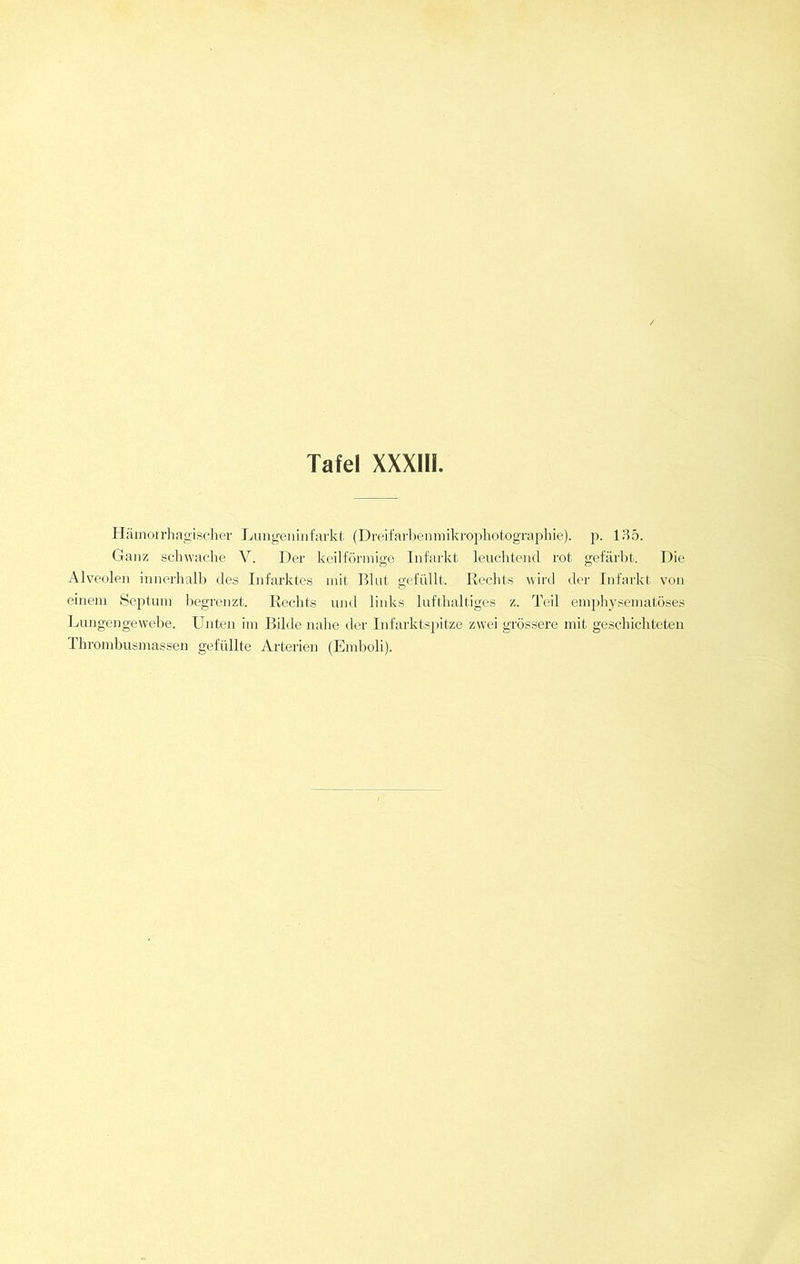 Hämorrhagischer Lungeninfarkt (Dreifarbenmikrophotographie), p. 135. Ganz schwache V. Der keilförmige Infarkt leuchtend rot gefärbt. Die Alveolen innerhalb des Infarktes mit Blut gefüllt. Rechts wird der Infarkt von einem Septum begrenzt. Rechts und links lufthaltiges z. Teil emphysematoses Lungengewebe. Unten im Bilde nahe der Infarktspitze zwei grössere mit geschichteten rhrombusmassen gefüllte Arterien (Emboli).