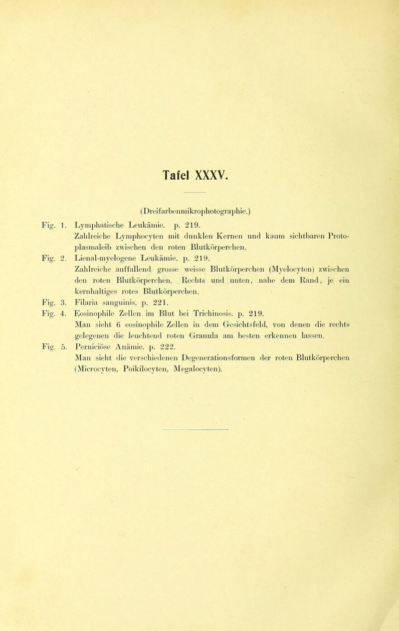 (Dreifarbenmikrophotogräphie.) Fig. 1. Lymphatische Leukämie, p. 219. Zahlreiche Lymphocyten mit dunklen Kernen und kaum sichtbaren Proto- plasmaleib zwischen den roten Blutkörperchen. Fig. 2. Lienal-myelogene Leukämie, p. 219. Zahlreiche auffallend grosse weisse Blutkörperchen (Myelocyten) zwischen den roten Blutkörperchen. Rechts und unten, nahe dem Rand, je ein kernhaltiges rotes Blutkörperchen. Fig. 3. Filaria sanguinis, p. 221. Fig. 4. Eosinophile Zellen im Blut bei Trichinosis. p. 219. Man sieht 6 eosinophile Zellen in dem Gesichtsfeld, von denen die rechts gelegenen die leuchtend roten Granula am besten erkennen lassen. Fig. 5. Perniciöse Anämie, p. 222. Man sieht die verschiedenen Degenerationsformen der roten Blutkörperchen (Microcyten, Poikilocyten, Megalocyten).
