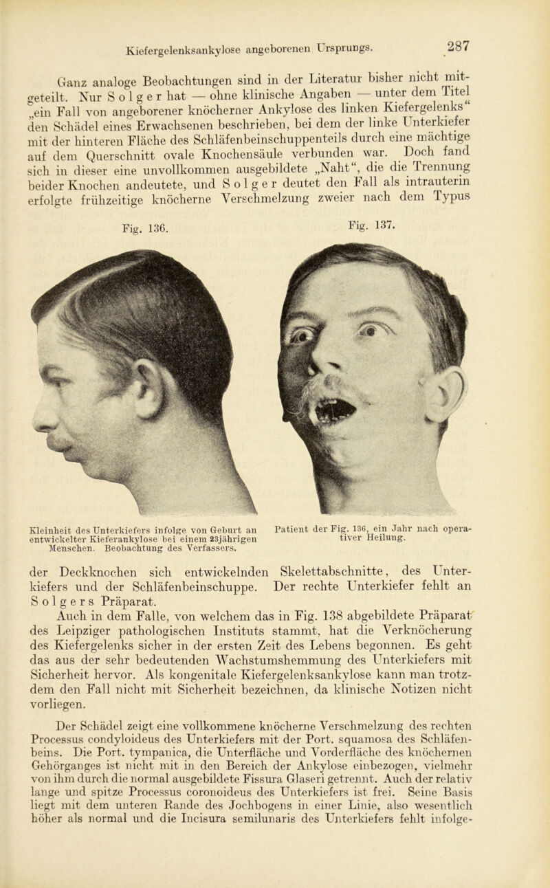 Ganz analoge Beobachtungen sind in der Literatur bisher nicht mit- geteilt. Nur S o 1 g e r hat — ohne klinische Angaben — unter dem Titel ?,ein Fall von angeborener knöcherner Ankylose des linken Kiefergelenks“ den Schädel eines Erwachsenen beschrieben, bei dem der linke Unterkiefer mit der hinteren Fläche des Schläfenbeinschuppenteils durch eine mächtige auf dem Querschnitt ovale Knochensäule verbunden war. Doch fand sich in dieser eine unvollkommen ausgebildete „Naht , die die Trennung beider Knochen andeutete, und S o 1 g e r deutet den Fall als intrauterin erfolgte frühzeitige knöcherne Verschmelzung zweier nach dem Typus Fig. 136. Fig. 137. Kleinheit des Unterkiefers infolge von Geburt an Patient der Fig. 136, ein Jahr nach opera- entwickelter Kieferankylose bei einem 23jährigen tiver Heilung. Menschen. Beobachtung des Verfassers. der Deckknochen sich entwickelnden Skelettabschnitte, des I nter- kiefers und der Schläfenbeinschuppe. Der rechte Unterkiefer fehlt an S o 1 g e r s Präparat. Auch in dem Falle, von welchem das in Fig. 138 abgebildete Präparat des Leipziger pathologischen Instituts stammt, hat die Verknöcherung des Kiefergelenks sicher in der ersten Zeit des Lebens begonnen. Es geht das aus der sehr bedeutenden Wachstumshemmung des Unterkiefers mit Sicherheit hervor. Als kongenitale Kiefergelenksankylose kann man trotz- dem den Fall nicht mit Sicherheit bezeichnen, da klinische Notizen nicht vorliegen. Der Schädel zeigt eine vollkommene knöcherne Verschmelzung des rechten Processus condyloideus des Unterkiefers mit der Port, squamosa des Schläfen- beins. Die Port, tympanica, die Unterfläche und Vorderfläche des knöchernen Gehörganges ist nicht mit in den Bereich der Ankylose einbezogen, vielmehr von ihm durch die normal ausgebildete Fissura Glaseri getrennt. Auch der relativ lange und spitze Processus coronoideus des Unterkiefers ist frei. Seine Basis liegt mit dem unteren Bande des Jochbogens in einer Linie, also wesentlich höher als normal und die Incisura semilunaris des Unterkiefers fehlt infolge-