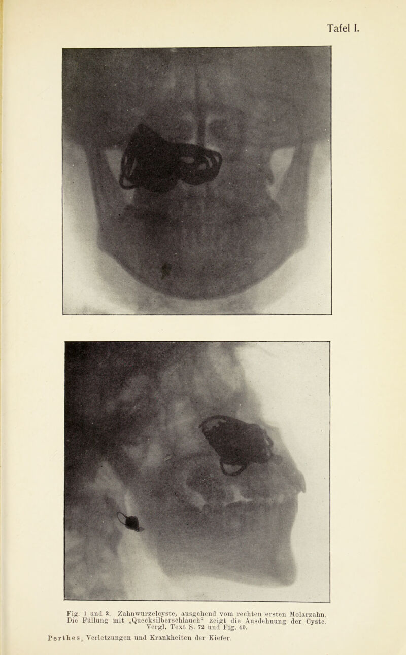 Fig. l und 2. Zahnwurzelcyste, ausgehend vom rechten ersten Molarzalm. Die Füllung mit „Quecksilberschlauch“ zeigt die Ausdehnung der Cyste. Vergl. Text S. 72 und Fig. 40.