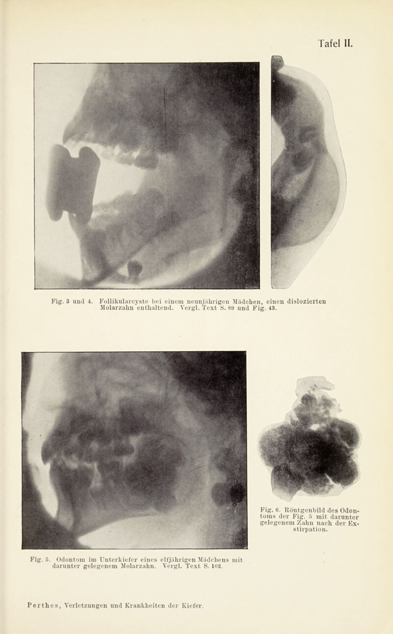 Fig. 3 und 4. Follikularcyste bei einem neunjährigen Mädchen, einen dislozierten Molarzahn enthaltend. Yergl. Text S. 89 und Fig. 43. Fig. 6. Röntgenbild des Odon- toms der Fig. 5 mit darunter gelegenem Zahn nach der Ex- stirpation. Fig. 5. Odontom im Unterkiefer eines darunter gelegenem Molarzahn. elfjährigen Mädchens mit Yergl. Text S. 102.