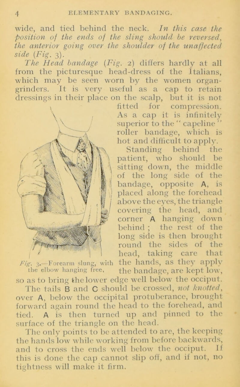 wide, and tied behind the neck. In this case the position of the ends of the sling should be reversed, the anterior going over the shoulder of the unaffected side {Fig. 3). The Head bandage {Fig. 2) differs hardly at all from the picturesque head-dress of the Italians, which may be seen worn by the women organ- grinders. It is very useful as a cap to retain dressings in their place on the scalp, but it is not fitted for compression. As a cap it is infinitely superior to the “ capeline ” roller bandage, which is hot and difficult to apply. Standing behind the patient, who should be sitting down, the middle of the long side of the bandage, opposite A, is placed along the forehead above the eyes, the triangle covering the head, and corner A hanging down behind ; the rest of the long side is then brought round the sides of the head, taking care that the hands, as they apply the bandage, are kept low, so as to bring the lower edge well below the occiput. The tails B and C should be crossed, not knotted, over A, below the occipital protuberance, brought forward again round the head to the forehead, and tied. A is then turned up and pinned to the surface of the triangle on the head. The only points to be attended to arc, the keeping the hands low while working from before backwards, and to cross the ends well below the occiput. If this is done the cap cannot slip off, and if not, no tightness will make it firm. Fig. 3.—Forearm slung, with the elbow hanging free,