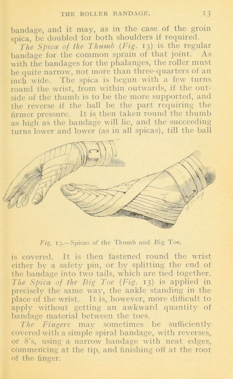 bandage, and it may, as in the case of the groin spica, be doubled for both shoulders if required. The Spica of the Thumb (Fig. 13) is the regular bandage for the common sprain of that joint. As with the bandages for the phalanges, the roller must be quite narrow, not more than three-quarters of an inch wide. The spica is begun with a few turns round the wrist, from within outwards, if the out- side of the thumb is to be the more supported, and the reverse if the ball be the part requiring the firmer pressure. It is then taken round the thumb as high as the bandage will lie, and the succeeding turns lower and lower (as in all spicas), till the ball Fig. 13.—Spicas of the Thumb and Big Toe. is covered. It is then fastened round the wrist either by a safety pin, or by splitting the end of the bandage into two tails, which are tied together. The Spica of the Big Toe (Fig. 13) is applied in precisely the same way, the ankle standing in the place of the wrist. It is, however, more difficult to apply without getting an awkward quantity of bandage material between the toes. The Fingers may sometimes be sufficiently covered with a simple spiral bandage, with reverses, or 8’s, using a narrow bandage with neat edges, commencing at the tip, and finishing off at the root of the finger.