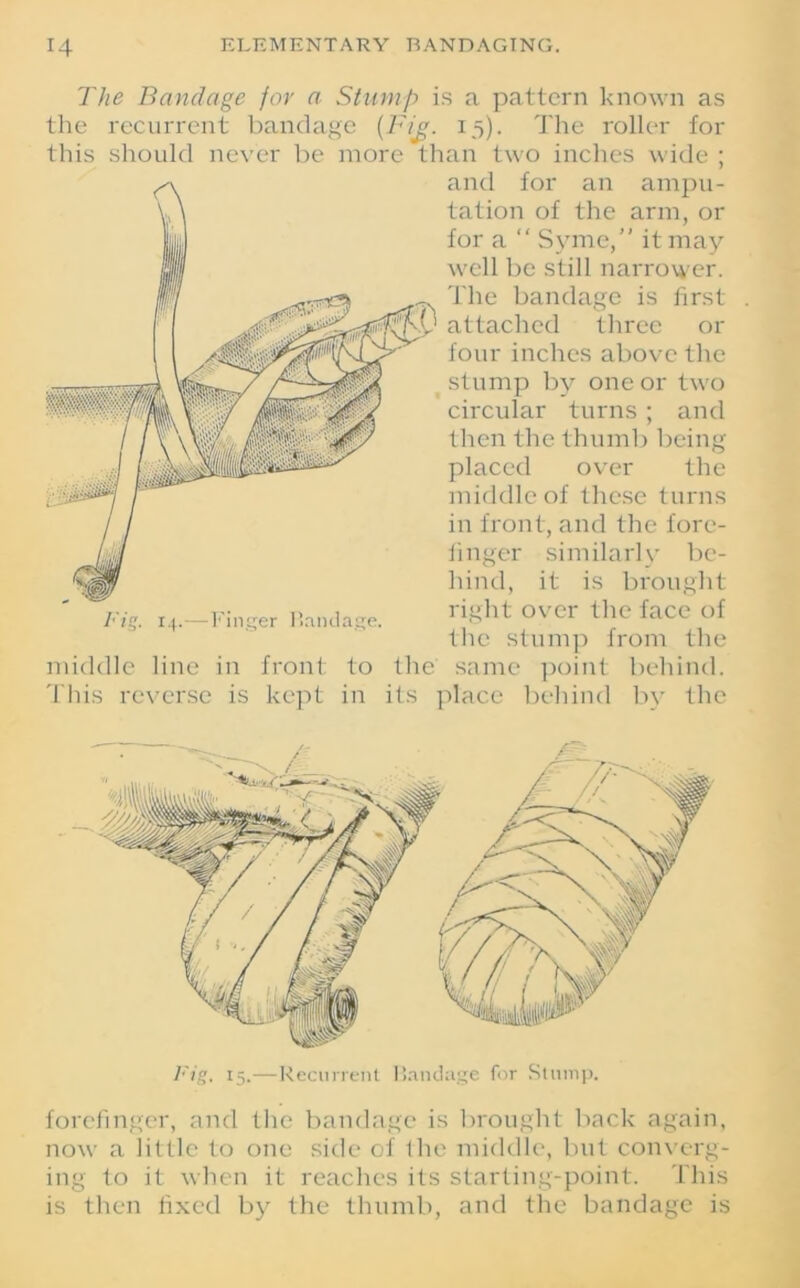 The Bandage for a Stump is a pattern known as the recurrent bandage (Fu15). The roller for this should never be more than two inches wide ; and for an ampu- tation of the arm, or for a “ Syme,” it may well be still narrower. The bandage is first attached three or four inches above the stump by one or two circular turns ; and then the thumb being placed over the middle of these turns in front, and the fore- finger similarly be- hind, it is brought right over the face of the stump from the same point behind. Fig. 14.—Finger Iiandage. middle line in This reverse is front kept to the in its place behind by the Fig. 15.—Recurrent Bandage for Stump. forefinger, and the bandage is brought back again, now a little to one side of the middle, but converg- ing to it when it reaches its starting-point. This is then fixed by the thumb, and the bandage is