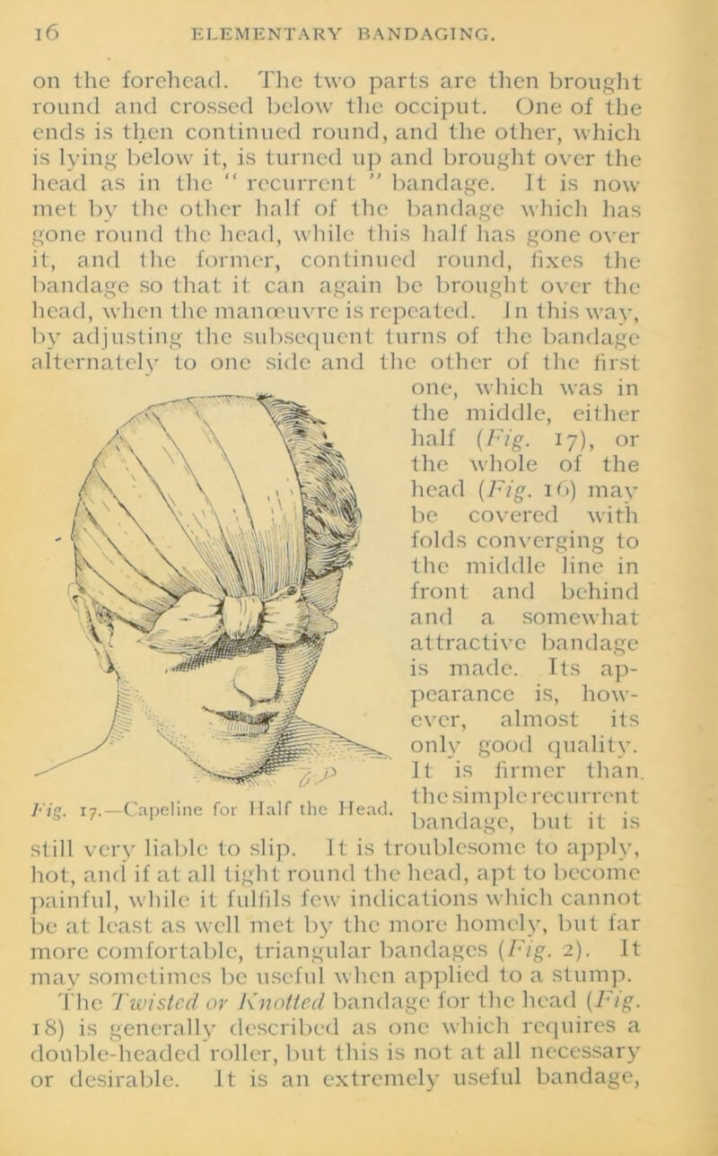 on the forehead. The two parts are then brought round and crossed below the occiput. One of the ends is then continued round, and the other, which is lying below it, is turned up and brought over the head as in the “ recurrent  bandage. It is now met by the other half of the bandage which has gone round the head, while this half has gone over it, and the former, continued round, fixes the bandage so that it can again be brought over the head, when the manoeuvre is repeated. 1 n this way, by adjusting the subsequent turns of the bandage alternately to one side and the other of the first- one, which was in the middle, either half (Fig. 17), or the whole of the head (Fig. 16) may be covered with folds converging to the middle line in front and behind and a somewhat attractive bandage is made. Its ap- pearance is, how- ever, almost its only good quality. It is firmer than, the sim pie recurren t bandage, but it is still very liable to slip. It is troublesome to apply, hot, and if at all tight round the head, apt to become painful, while it fulfils few indications which cannot be at least as well met by the more homely, but far more comfortable, triangular bandages (Fig. 2). It may sometimes be useful when applied to a stump. The Twisted or Knotted bandage for the head (Fig. 18) is generally described as one which requires a double-headed roller, but this is not at all necessary or desirable. It is an extremely useful bandage, Fig. 17.—Capeline for Half the Head.