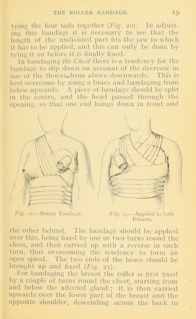 tying the four tails together {Fig. 20). In adjust- ing this bandage it is necessary to see that the length of the undivided part fits the jaw to which it has to be applied, and this can only be done by tying it 011 before it is finally fixed. In bandaging the Chest there is a tendency for the bandage to slip down on account of the decrease in size of the thorax.from above downwards. This is best overcome by using a brace and bandaging from below upwards. A piece of bandage should be split in the centre, and the head passed through the opening, so that one end hangs down in front and the other behind. The bandage should be applied over this, being fixed by one or two turns round the chest, and then carried up with a reverse in each turn, thus overcoming the tendency to form an open spiral. The two ends of the brace should be brought up and fixed {Fig. 21). For bandaging the breast the roller is first fixed by a couple of turns round the chest, starting from and below the affected gland ; it is then carried upwards over the lower part of the breast and the opposite shoulder, descending across the back to