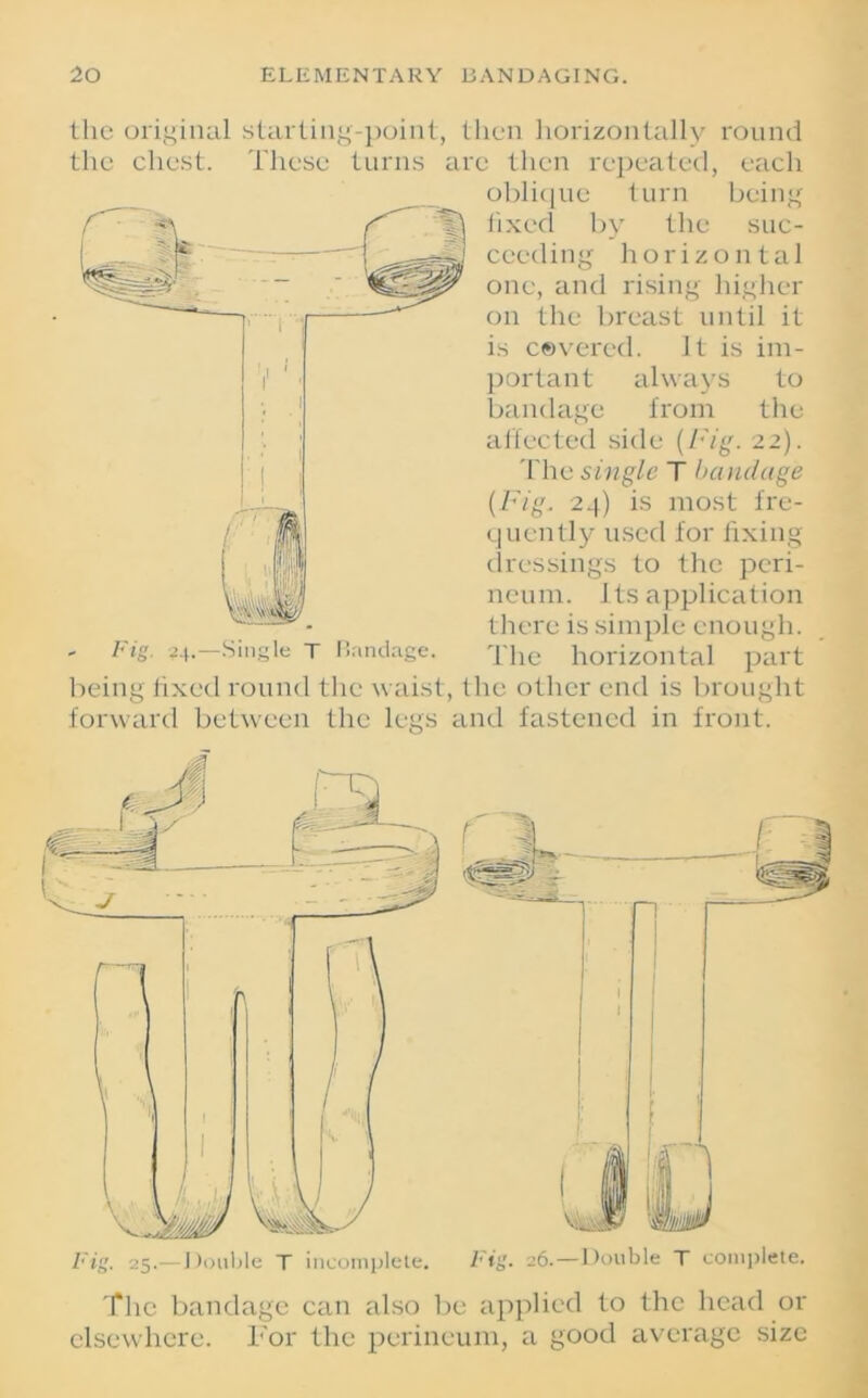 the original starting-point, then horizontally round the chest. These turns are then repeated, each oblique turn being fixed by the suc- ceeding horizontal one, and rising higher on the breast until it is covered. It is im- portant always to bandage from the affected side (Fig. 22). 'Flic single T hand age (Fig. 24) is most fre- quently used for fixing dressings to the peri- neum. Its application there is simple enough. The horizontal part being fixed round the waist, the other end is brought forward between the legs and fastened in front. The bandage can also be applied to the head or elsewhere. For the perineum, a good average size