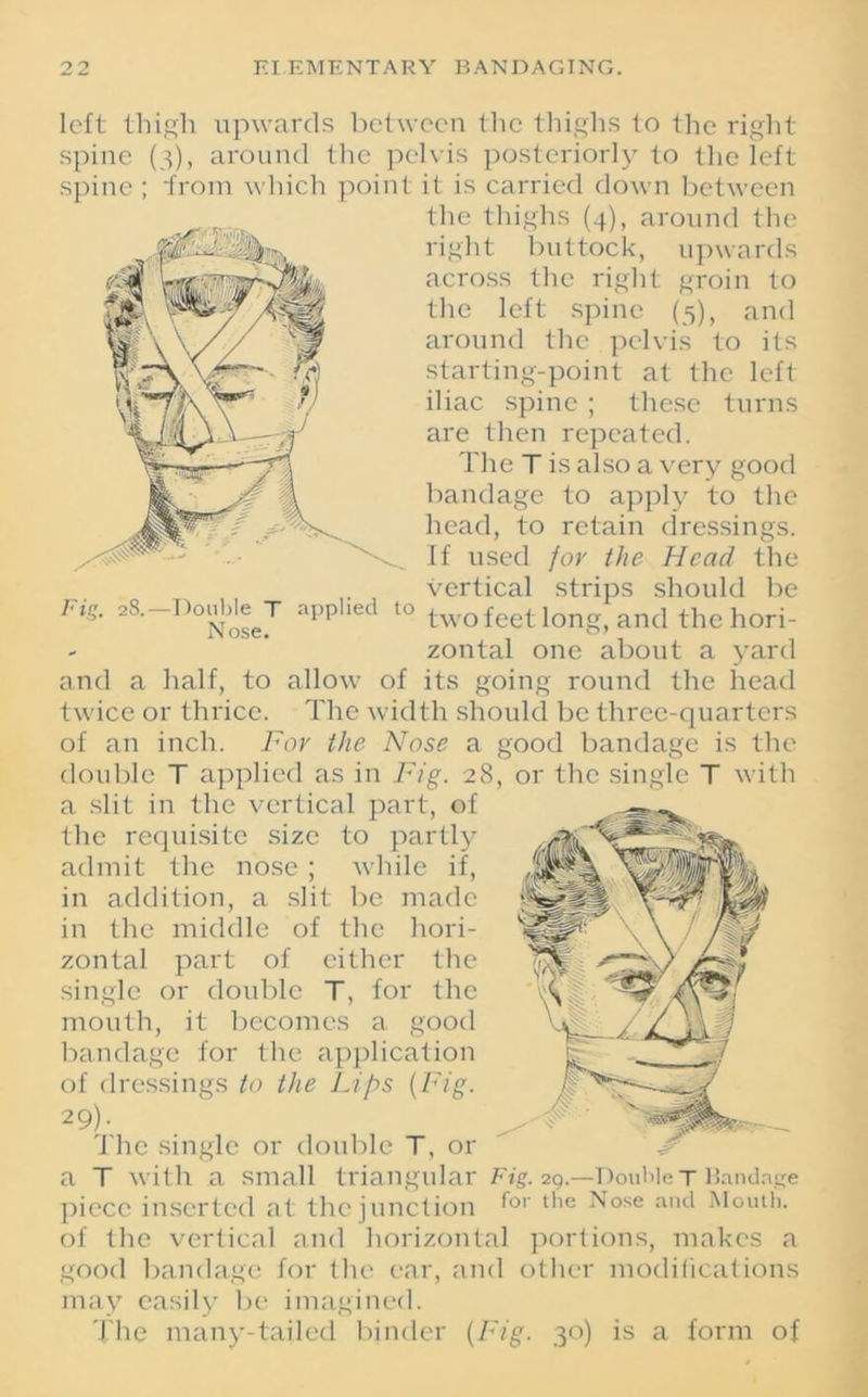 left thigh upwards between the thighs to the right spine (3), around the pelvis posteriorly to the left spine ; from which point it is carried down between the thighs (4), around the right buttock, upwards across the right groin to the left spine (5), and around the pelvis to its starting-point at the left iliac spine ; these turns are then repeated. The T is also a very good bandage to apply to the head, to retain dressings. If used for the Head the vertical strips should be Fis. =8.-Rouble j applied to two feet long, and the hori- zontal one about a yard and a half, to allow of its going round the head twice or thrice. The width should be three-quarters of an inch. For the Nose a good bandage is the double T applied as in Fig. 28, or the single T with a slit in the vertical part, of the requisite size to partly admit the nose ; while if, in addition, a slit be made in the middle of the hori- zontal part of cither the single or double T, for the mouth, it becomes a good bandage for the application of dressings to the Lips (Fig. 29). The single or double T, or a T with a small triangular Fig. 29.—Double T Bandnge piece inserted at the junction for the Nose and ^loutl)- of the vertical and horizontal portions, makes a good bandage for the ear, and other modifications may easily be imagined. The many-tailed binder (Fig. 30) is a form of