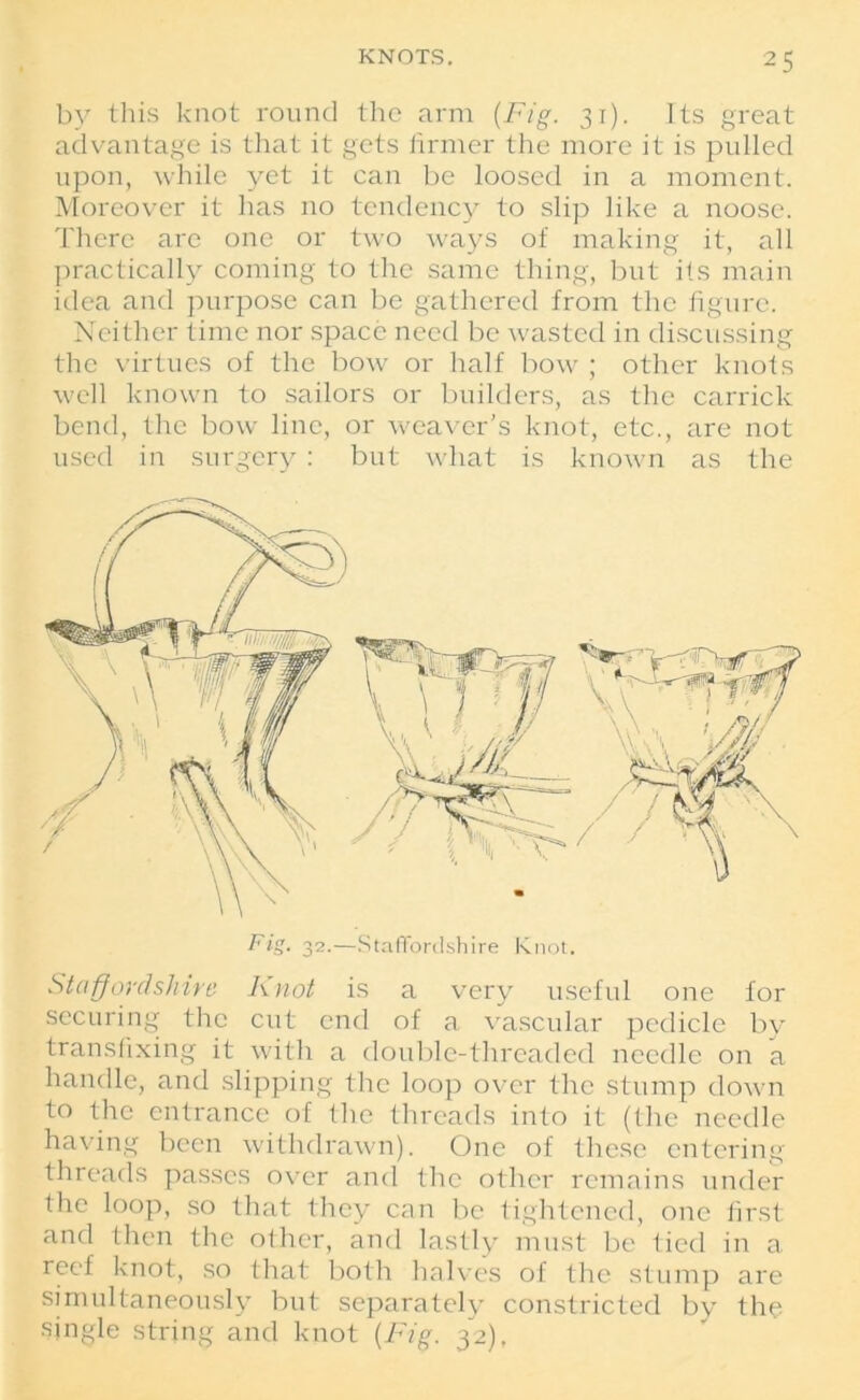 by this knot round the arm (Fig. 31). Its great advantage is that it gets firmer the more it is pulled upon, while yet it can be loosed in a moment. Moreover it has no tendency to slip like a noose. There are one or two ways of making it, all practically coming to the same thing, but its main idea and purpose can be gathered from the figure. Neither time nor space need be wasted in discussing the virtues of the bow or half bow ; other knots well known to sailors or builders, as the carrick bend, the bow line, or weaver's knot, etc., are not used in surgery : but what is known as the Staffordshire Knot is a very useful one for securing the cut end of a vascular pedicle by transfixing it with a double-threaded needle on a handle, and slipping the loop over the stump down to the entrance of the threads into it (the needle having been withdrawn). One of these entering threads passes over and the other remains under the loop, so that they can be tightened, one first and then the other, and lastly must be tied in a reef knot, so that both halves of the stump are simultaneously but separately constricted by the single string and knot (Fig. 32),