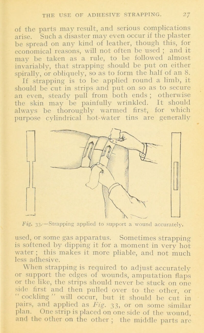 of the parts may result, and serious complications arise. Such a disaster may even occur if the plaster be spread ou any kind of leather, though this, for economical reasons, will not often be used ; and it may be taken as a rule, to be followed almost invariably, that strapping should be put on either spirally, or obliquely, so as to form the half of an 8. If strapping is to be applied round a limb, it should be cut in strips and put on so as to secure an even, steady pull from both ends ; otherwise the skin may be painfully wrinkled. It should always be thoroughly warmed first, for which purpose cvlindrical hot-water tins are generally used, or some gas apparatus. Sometimes strapping is softened by dipping it for a moment in very hot water ; this makes it more pliable, and not much less adhesive. When strapping is required to adjust accurately or support the edges of wounds, amputation flaps or the like, the strips should never be stuck on one side first and then pulled over to the other, or “cockling” will occur, but it should be cut in pairs, and applied as Fig. 33, or on some similar plan. One strip is placed on one side of the wound, and the other on the other ; the middle parts arc
