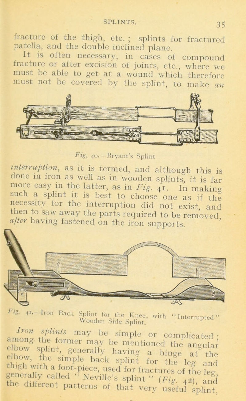 fracture of the thigh, etc. ; splints for fractured patella, and the double inclined plane. It is often necessary, in cases of compound fracture or after excision of joints, etc., where we must be able to get at a wound which therefore must not be covered by the splint, to make an Fig, 40.— Bryant’s Splint interruption, as it is termed, and although this is done in iron as well as in wooden splints, it is far more easy in the latter, as in Fig. 41.' I„ making such a splint it is best to choose one as if the necessity for the interruption did not exist and then to saw away the parts required to be removed after having fastened, on the iron supports. with “Interrupted Fig. 4i.—Iron Back Splint for the Knee, Wooden Side Splint.’ a mom* rhlT' be, simpIe or complicated ; among the former may be mentioned the aneula elbow splint, generally having a hinge at the elbow, the simple back splint for ST leg and high with a foot-piece, used for fractures of the leg generally called “ Neville’s splint ” (Fig 42) and the different patterns of that very usfful splint