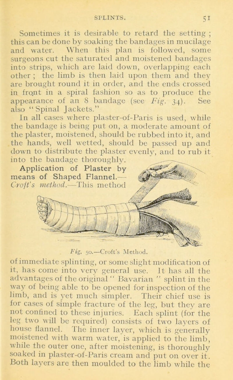 Sometimes it is desirable to retard the setting ; this can be done by soaking the bandages in mucilage and water. When this plan is followed, some surgeons cut the saturated and moistened bandages into strips, which are laid down, overlapping each other ; the limb is then laid upon them and they are brought round it in order, and the ends crossed in front in a spiral fashion so as to produce the appearance of an 8 bandage (see Fig. 34). See also “Spinal Jackets.” In all cases where plaster-of-Paris is used, while the bandage is being put on, a moderate amount of the plaster, moistened, should be rubbed into it, and the hands, well wetted, should be passed up and down to distribute the plaster evenly, and to rub it into the bandage thoroughly. Application of Plaster by means of Shaped Flannel.— Croft’s method.—This method Fig, 50.—Croft’s Method. of immediate splinting, or some slight modification of it, has come into very general use. It has all the advantages of the original “ Bavarian ” splint in the way of being able to be opened for inspection of the limb, and is yet much simpler. Their chief use is for cases of simple fracture of the leg, but they are not confined to these injuries. Each splint (for the leg two will be required) consists of two layers of house flannel. The inner layer, which is generally moistened with warm water, is applied to the limb, while the outer one, after moistening, is thoroughly soaked in plaster-of-Paris cream and put on over it. Both layers are then moulded to the limb while the