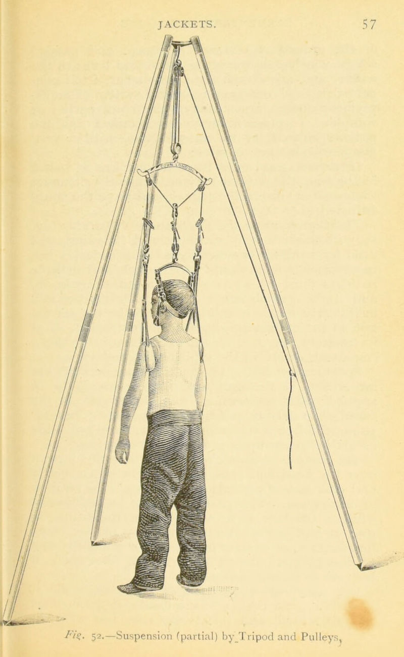 Fio. 52.—Suspension (partial) by Tripod and Pulleys,