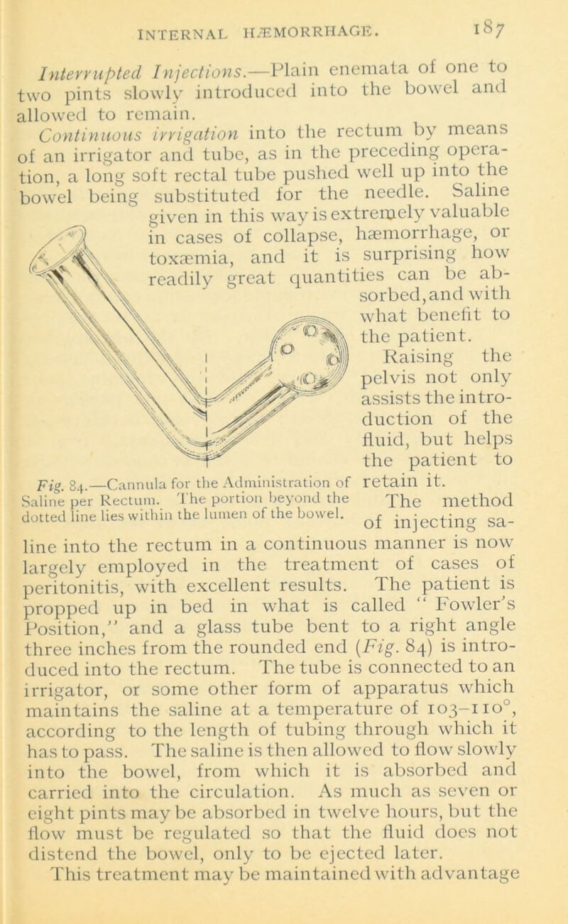 Interrupted, Injections.—Plain enemata of one to two pints slowly introduced into the bowel and allowed to remain. Continuous irrigation into the rectum by means of an irrigator and tube, as in the preceding opera- tion, a long soft rectal tube pushed well up into the bowel being substituted for the needle. Saline given in this way is extremely valuable in cases of collapse, haemorrhage, or toxaemia, and it is surprising how readily great quantities can be ab- sorbed, and with what benefit to the patient. Raising the pelvis not only assists the intro- duction of the fluid, but helps the patient to pig g4,—Cannula for the Administration of retain it. Saline per Rectum. The portion beyond the The method dotted line lies within the lumen of the bowel. ^ • ect jn„. sa_ line into the rectum in a continuous manner is now largely employed in the treatment of cases of peritonitis, with excellent results. The patient is propped up in bed in what is called “ Fowler’s Position,” and a glass tube bent to a right angle three inches from the rounded end (Fig. 84) is intro- duced into the rectum. The tube is connected to an irrigator, or some other form of apparatus which maintains the saline at a temperature of 103-110°, according to the length of tubing through which it has to pass. The saline is then allowed to flow slowly into the bowel, from which it is absorbed and carried into the circulation. As much as seven or eight pints may be absorbed in twelve hours, but the flow must be regulated so that the fluid does not distend the bowel, only to be ejected later. This treatment may be maintained with advantage