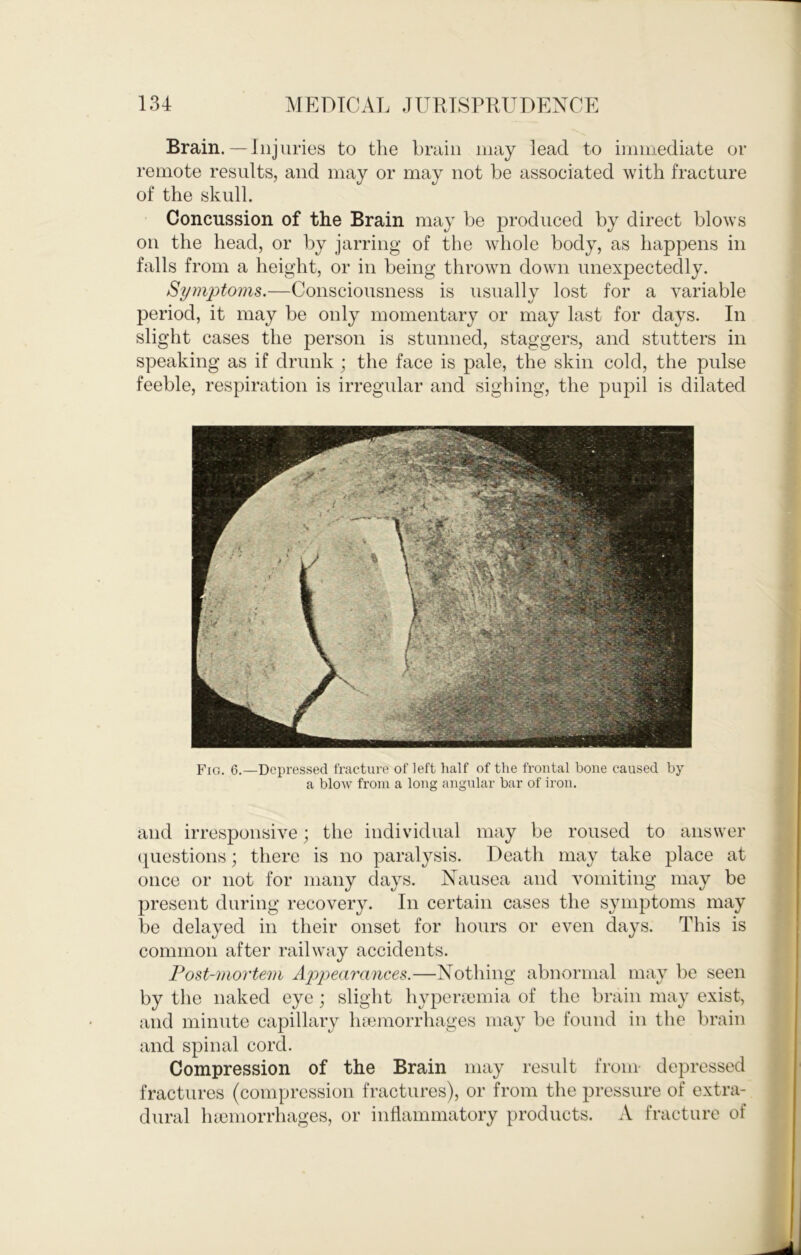 Brain.—Illjuries to the brain may lead to immediate or remote results, and may or may not be associated with fracture of the skull. Concussion of the Brain may be produced by direct blows on the head, or by jarring of the whole body, as happens in falls from a height, or in being thrown down unexpectedly. Symptoms.—Consciousness is usually lost for a variable period, it may be only momentary or may last for days. In slight cases the person is stunned, staggers, and stutters in speaking as if drunk ; the face is pale, the skin cold, the pulse feeble, respiration is irregular and sighing, the pupil is dilated Fig. 6.—Depressed fracture of left half of the frontal bone caused by a blow from a long angular bar of iron. and irresponsive; the individual may be roused to answer (questions; there is no paralysis. Death may take place at once or not for many days. Nausea and vomiting may be present during recovery. In certain cases the symptoms may be delayed in their onset for hours or even days. This is common after railway accidents. Post-mortem Appearances.—Nothing abnormal may be seen by the naked eye; slight hypertemia of the brain may exist, and minute capillary hfemorrhages may be found in the brain and spinal cord. Compression of the Brain may result from- depressed fractures (compression fractures), or from the pressure of extra- dural luemorrhages, or inflammatory products. A fracture of