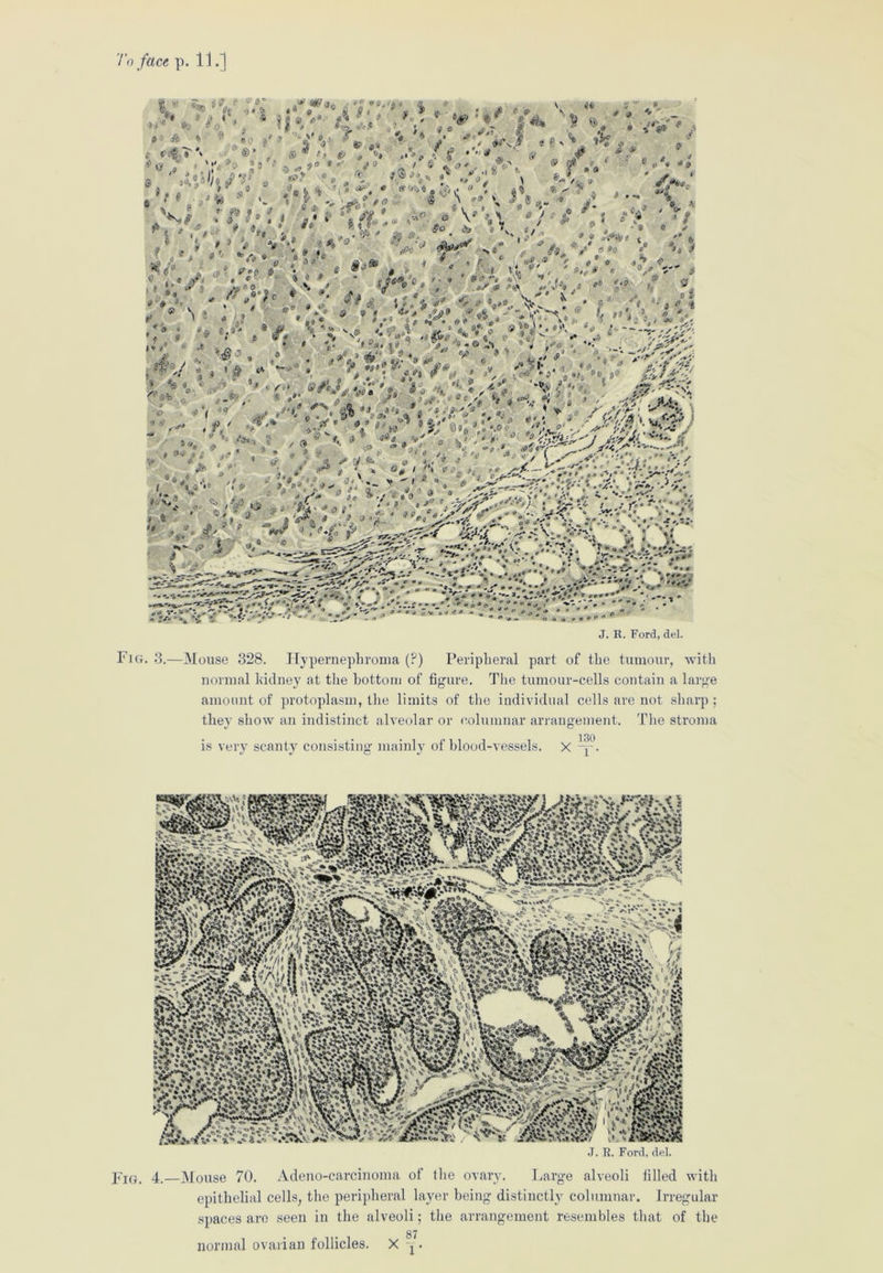 J. R. Ford, del. Fig. 3.—Mouse 328. Hypernephroma (?) Peripheral part of the tumour, with normal kidney at the bottom of figure. The tumour-cells contain a large amount of protoplasm, the limits of the individual cells are not sharp ; they show an indistinct alveolar or columnar arrangement. The stroma 130 is very scanty consisting mainly of blood-vessels, x -y. J. R. Ford, del. Fig. 4.—Mouse 70. Adeno-carcinoma of the ovary. Large alveoli filled with epithelial cells, the peripheral layer being distinctly columnar. Irregular spaces are seen in the alveoli; the arrangement resembles that of the 87