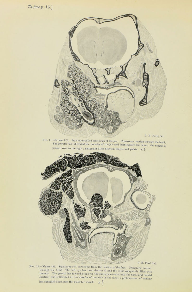 Fig. J. B. Ford, del. Fi«. 11 .-Mouse 378. Squa,nous-celled carcinoma of the jaw. Transverse section through the head The growth has infiltrated the muscles of the jaw and disintegrated the bone ; the tongue is pressed over to the right; malignant ulcer between tongue and palate, x f • 12.—Mouse 486. Squamous-cell carcinoma from the surface of the face. Transverse section through the head. The left eye has been destroyed and the orbit completely filled with tumour. The growth lias formed a cap over the skull, penetrated into the nasal and cranial cavities, and infiltrated all the muscles of one side of the face; a prolongation of tumour has extended down into (he masseter muscle, x -•