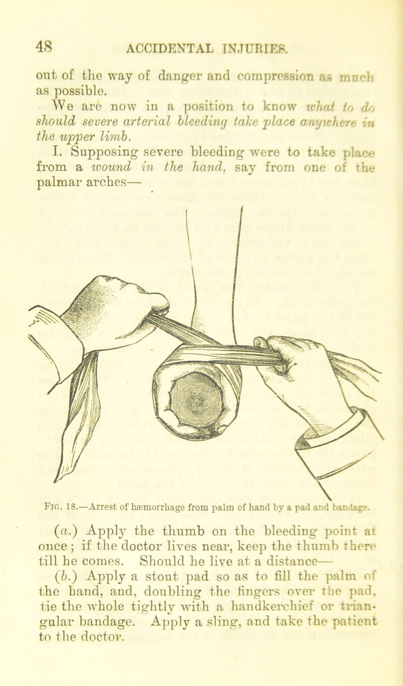 out of fclie way of danger and compregsion ag mncli as possible. \Ve are now in a position to know whai to d/j should severe arterial hleeding take place anywhere in the upper limb. I. Supposing severe bleeding were to take place from a wound in the hand, say from one of the palmar arches— (a.) Apply the thumb on the bleeding point at once ; if the doctor lives near, keep the thumb there till he comes. Should he live at a distance— (b.) Apply a stout jiad so as to fill the palm of the band, and, doubling the fingers over the pad. tie the whole tightly with a handkei'chief or trian- gular bandage. Aj)ply a sling, and take the patient to the doctor. Fin. 18.—Arrest of haimorrhage from palm of hand by a pad and bandage.