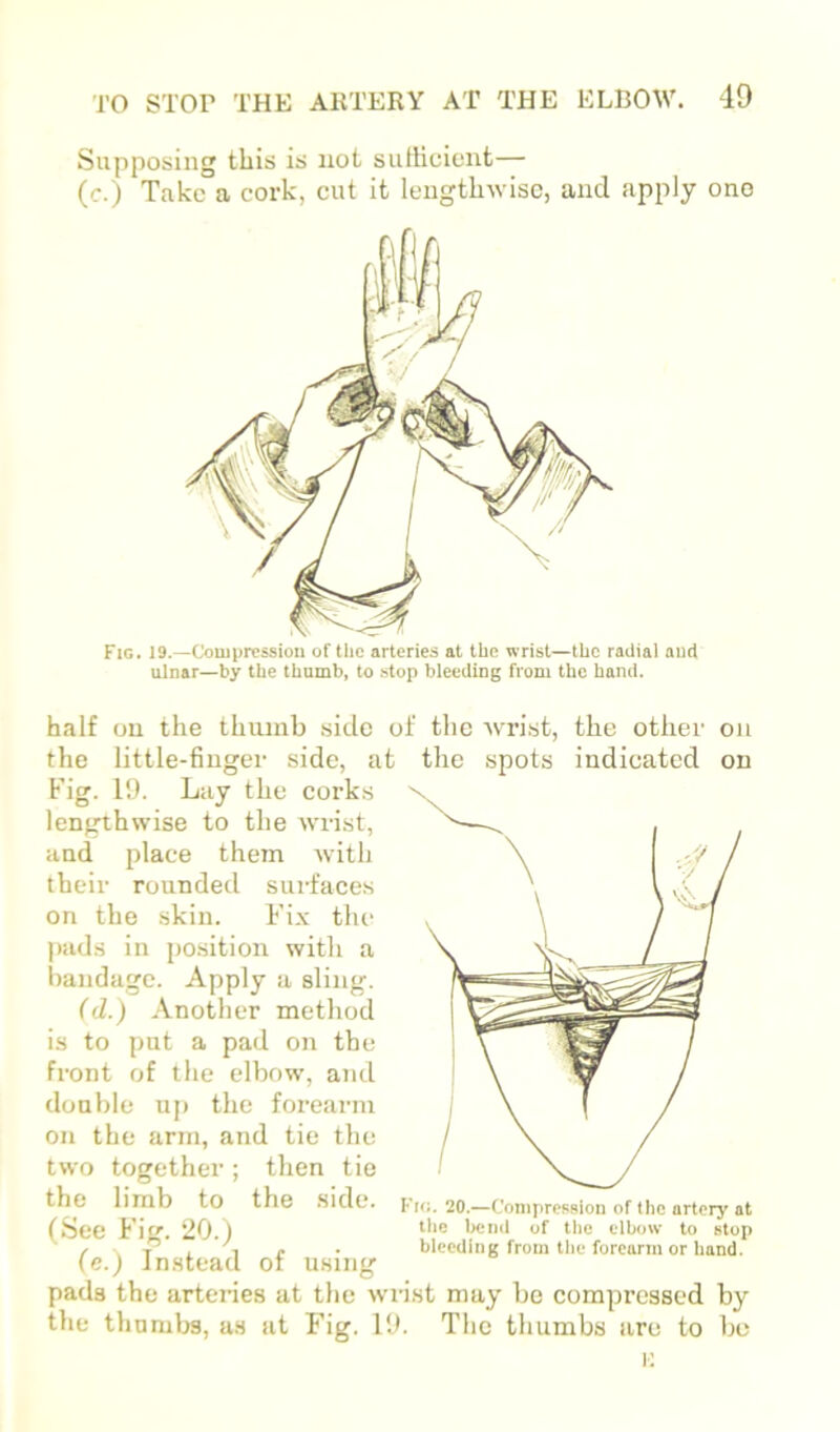 Supposing this is not sutticicnt— (c.) Take a cork, cut it lengthwise, and apply ono Fig. 19.—Couiprcssioii of the arteries at the wrist—the radial and ulnar—by the thumb, to stop bleeding from the hand. half on the thumb side of the wrist, the other on the little-finger side, at the spots indicated on Fig. 11). Lay the corks lengthwise to the wrist, and place them with their rounded surfaces on the skin. Fix the pads in position with a Iiandagc. Apply a sling. (d.) Another method is to put a pad on the front of the elbow, and double up the forearm on the arm, and tie the two together ; then tie the limb to the side. (See F’ig. 20.) Fit;. 20.—Cmijpression of the artery at the of the elbow to stop bleeding from the forearm or hand. (e.) Instead of usin^ pads the arteries at the wrist may be compressed by the thumbs, as at Fig. 19. The thumbs are to be