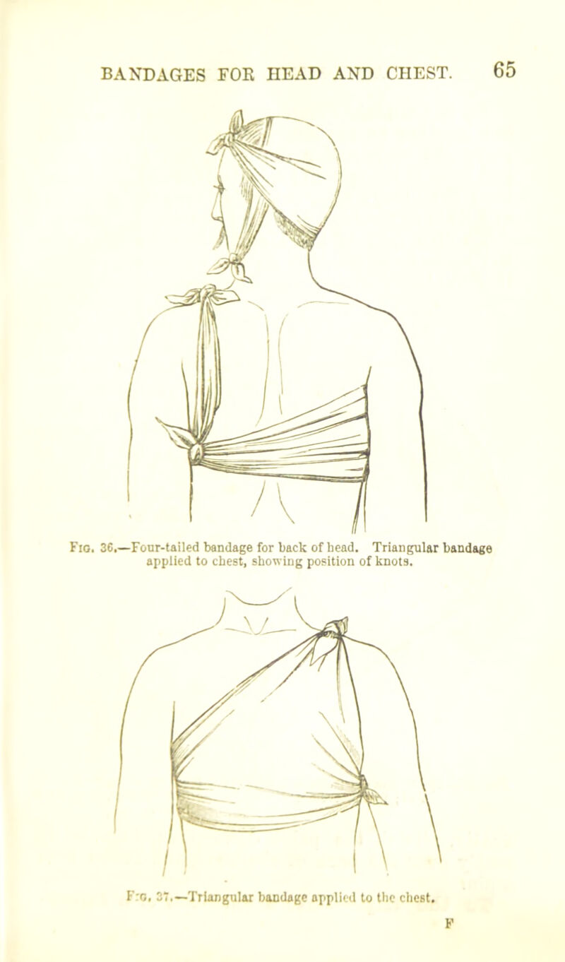 Fio. 36.—Four-tailed bandage for back of head. Triangular bandage applied to chest, showing position of knots. Fro. 37.—Triangular bandage applied to the chest.