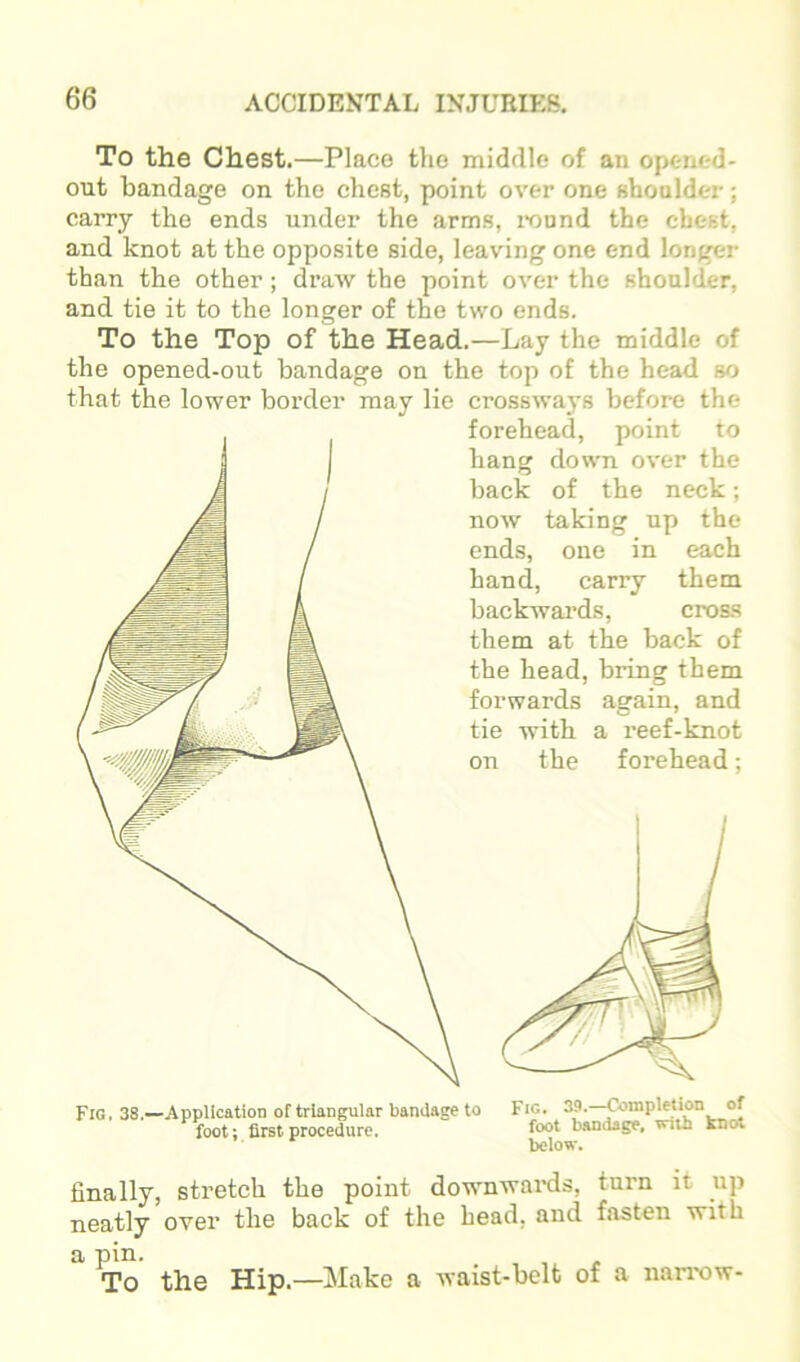 To the Chest.—Place the middle of an opened* out bandage on the chest, point over one shoalder; carry the ends under the arms, i-onnd the chest, and knot at the opposite side, leaving one end longer than the other; draw the point over the shoalder, and tie it to the longer of the two ends. To the Top of the Head.—Lay the middle of the opened-out bandage on the top of the head so that the lower border may lie crossways before the forehead, point to hang down over the back of the neck; now taking up the ends, one in each hand, carry them backwards, cross them at the back of the head, bring them forwards again, and tie with a reef-knot the forehead; on Fig. 38.—Application of triangular bandage to foot; first procedure. Fig. 39.—Completion of foot bandage, with knot below. finally, stretch the point downwards, turn it up neatly over the back of the head, and fasten with a pin. To the Hip.—Make a waist-belt of a nairow-