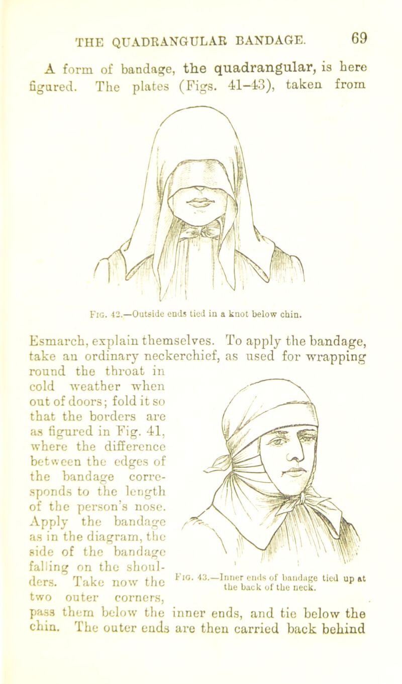 A form of bandaa:e, the quadrangular, is here figured. The plates (Figs. 41—4.3), taken from Kig. 42.—Outside ends tied in a knot below chin. Esmarch, explain themselves. To apply the bandage, take an ordinary neckerchief, as used for wrapping round the throat in cold weather when out of doors; fold it so that the borders are a.s figured in Fig. 41, where the difference between the edges of the bandage corre- sponds to the length of the person’s nose. Apply the bandage / as in the diagram, the side of the bandage falling on the shoul- ders. Take now' the two outer corners, pass them below the Fig. 43.—Inner ends of bandage tied up at the back of the neck. inner ends, and tic below the chin. The outer ends are then carried back behind