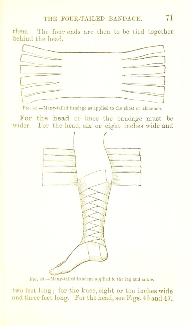 tliein. The four ends arc then to bo tied together behind the head. ViG. 4^.—Jlany-tailed bandage as applied to the chest or abdomen. For the head or knee the bandage must be wider. For the head, six or eight inches wide and Fig. 13.—Many-tailed Imndagc applied to the leg and ankle. two feet long; for the knee, eight or ten inches wide and three feet long. For the head, see Figs. 4G and 47.