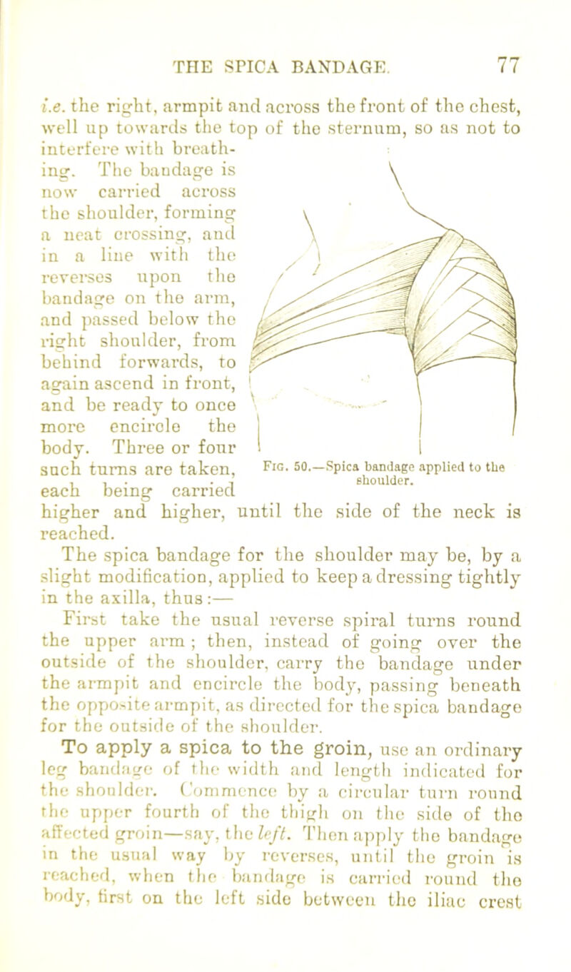 i.e. the right, armpit and across the front of the chest, well up towards the top of the sternum, so as not to interfere with breath- Fig. 50.—Spica bandage applied to the shoulder. ing. The bandage is now carried across the shoulder, forming a neat crossing, and in a line with the revei'sos upon the bandage on the arm, and passed below the right shoulder, from behind forwards, to again ascend in front, and be ready to once more encircle the body. Three or four such turns are taken, each being carried higher and higher, until the side of the neck is reached. The spica bandage for the shoulder may be, by a slight modification, applied to keep a dressing tightly in the axilla, thus:— Fii-st take the usual reverse spiral turns round the upper arm ; then, instead of going over the outside of the shoulder, carry the bandage under the armpit and encircle the body, passing beneath the opposite armpit, as directed for the spica bandage for the outside of the shoulder. To apply a spica to the groin, use an ordinary leg bandage of the width and length indicated for the shoulder, ('ommenco by a circular turn round the upper fourth of the thigh on the side of the affected groin—say, the left. Then apply the bandage in the usual way by reverses, until the groin is reached, when the bandage is carried round the body, first on the left side between the iliac cre.st