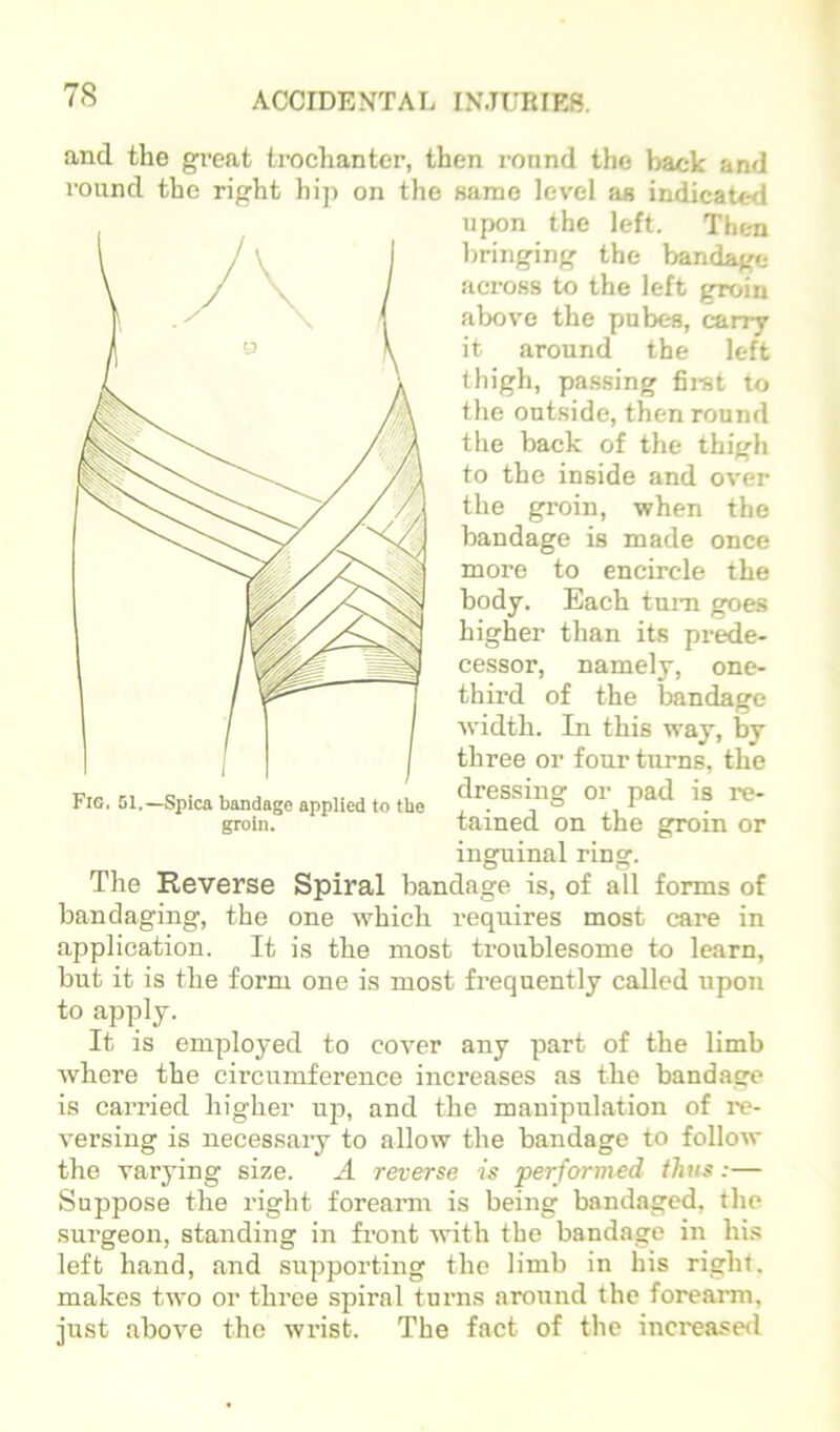 and the great trochanter, then round the back and round the right hip on the same level as indicated upon the left. Then bringing the bandage across to the left groin above the pubes, carry it around the left thigh, pa.ssing fiiut to the outside, then round the back of the thigh to the inside and over the groin, when the bandage is made once more to encircle the body. Each turn goes higher than its prede- cessor, namely, one- third of the bandage width. In this way, by three or four turns, the dressing or pad is re- tained on the groin or inguinal ring. The Reverse Spiral bandage is, of all forms of bandaging, the one which requires most care in application. It is the most troublesome to learn, but it is the form one is most frequently called upon to apply. It is employed to cover any part of the limb where the circumference increases as the bandage is carried higher up, and the manipulation of re- versing is necessary to allow the bandage to follow the varj'ing size. A reverse is performed thus;— Suppose the right forearm is being bandaged, the surgeon, standing in front with the bandage in his left hand, and supporting the limb in his right, makes two or three spiral turns around the forearm, just above the wx'ist. The fact of the increased