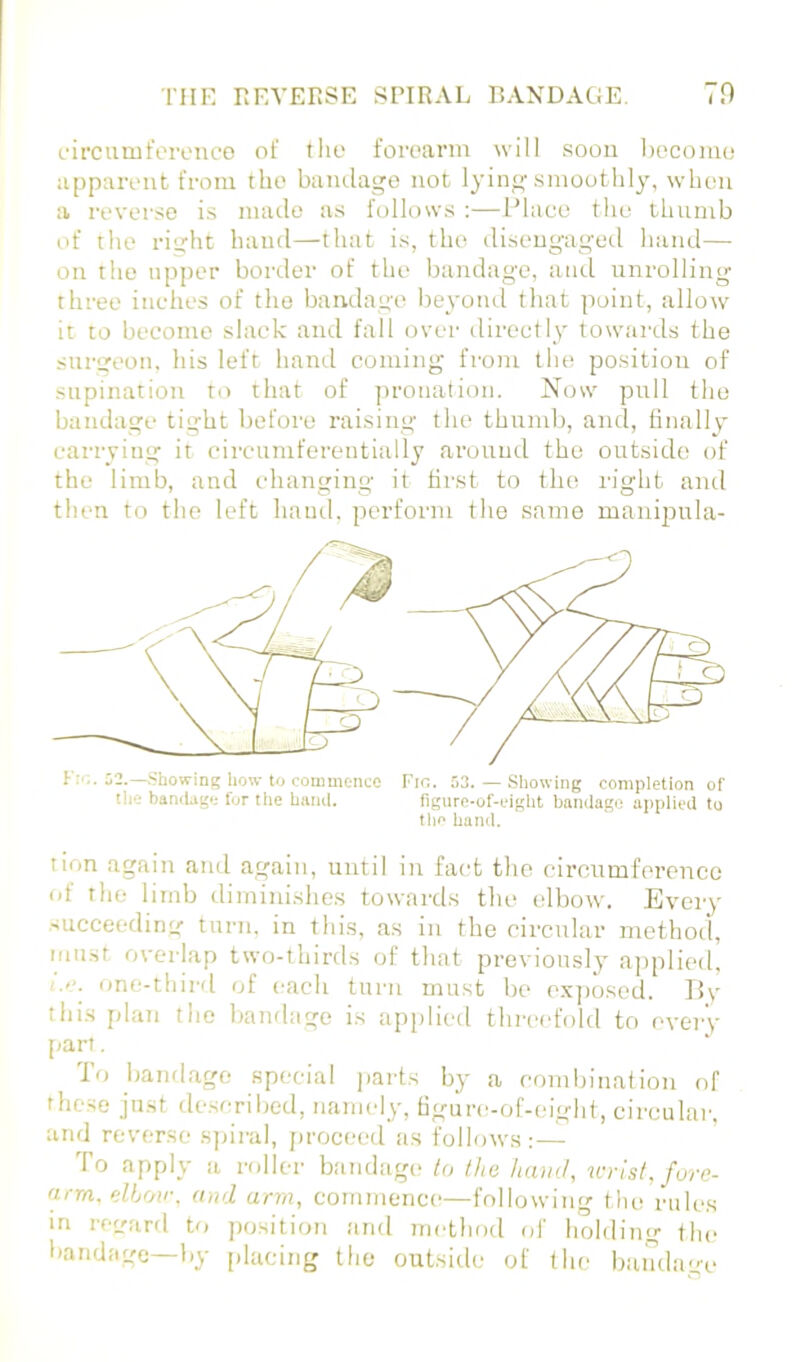 ■niK REVERSE SPIRAL BANDAGE. 70 (.'ii’cuuiferenco of tlie foroarm will soon l)ecomo appaivnt from the bandage not lying smoothly, when a reverse is made as follows ;—Idaoe the thumb of the right hand—that is, the disengaged hand— on the upper border of the bandage, ami unrolling three inches of the bandage beyond that point, allow it :o become slack and fall over directly towards the surgeon, his left hand coming from the position of supination to that of pronation. Now pull the bandage tight before raising the thumb, and, linally carrying it circumferentially around the outside of the limb, and changing it first to the right and then to the left hand, perform the same maniitula- lion again and again, until in fact the circumference <it the limb iliminishes towards the elbow. Every succeeding turn, in this, as in the circular method, niii.st overlap two-thirds of that previously a])plied, one-third of each turn must be ex])osed. 15v this plan the Itandage is applied thi-cefold to every [art. To bandage special parts by a combiuaiion of these ju.st described, namely, figure-of-eight, circular, and reverse sjnral, jiroceed as follows: — To apply a roller b.'indage lo the ham/, wrist, fure- (irm. elbow, and arm, cornmenct—following the rules in rer.oird to jiosition ;md method of holding the bandage—liy [ilacing the outsitle of the bandage