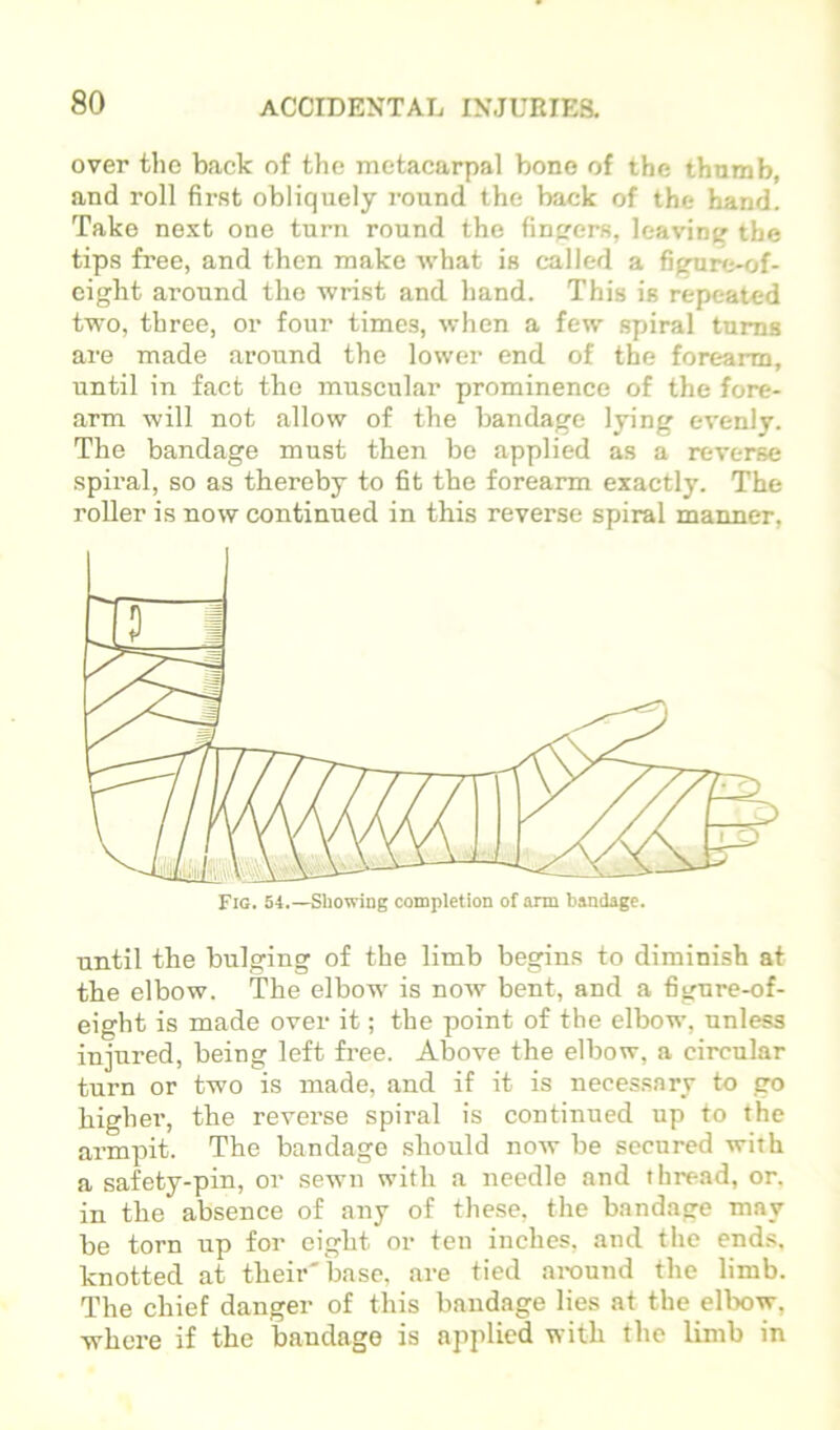 over the back of the metacarpal bone of the thnmb, and roll first obliquely round the back of the band. Take next one turn round the finprers, leaviner the tips free, and then make what is called a figure-of- eight around the wrist and hand. This is repeated two, three, or four times, when a few spiral turns are made around the lower end of the forearm, until in fact the muscular prominence of the fore- arm will not allow of the bandage lying evenly. The bandage must then be applied as a reverse spiral, so as thereby to fit the forearm exactly. The roller is now continued in this reverse spiral manner, until the bulging of the limb begins to diminish at the elbow. The elbow is now bent, and a figure-of- eight is made over it; the point of the elbow, unless injured, being left free. Above the elbow, a circular turn or two is made, and if it is necessary to go highei’, the reverse spiral is continued up to the armpit. The bandage should now be secured with a safety-pin, or sewn with a needle and thread, or, in the absence of any of these, the bandage may be torn up for eight or ten inches, and the ends, knotted at their'base, are tied around the limb. The chief danger of this bandage lies at the elbow, where if the bandage is applied with the limb in