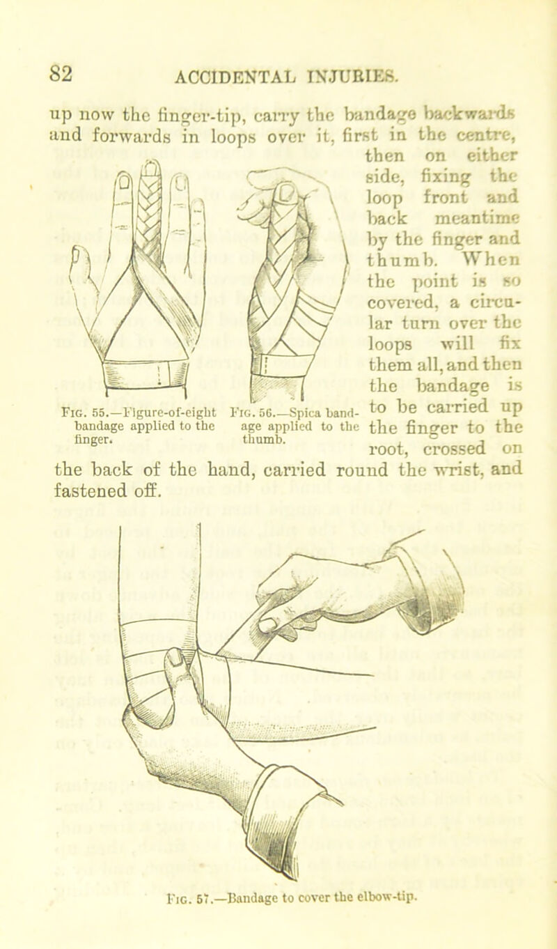 up now the tin^ev-tip, cany the bindago l>ackwa!-ds and forwards in loops over it, first in the centre, then on either side, fixing the loop front and hack meantime hy the finger and thumb. When the point is so covered, a circu- lar tuni over the loops will fix them all, and then the bandage is I'IG.OG.-Spicaband- to be carried up age applied to the the fingfer to the thumb. . ° j root, crossed on the back of the hand, carried round the wrist, and fastened off. Fig. 55.—I'lgure-of-eight bandage applied to the linger. Fig. 5“.—Bandage to cover the elbow-tip.