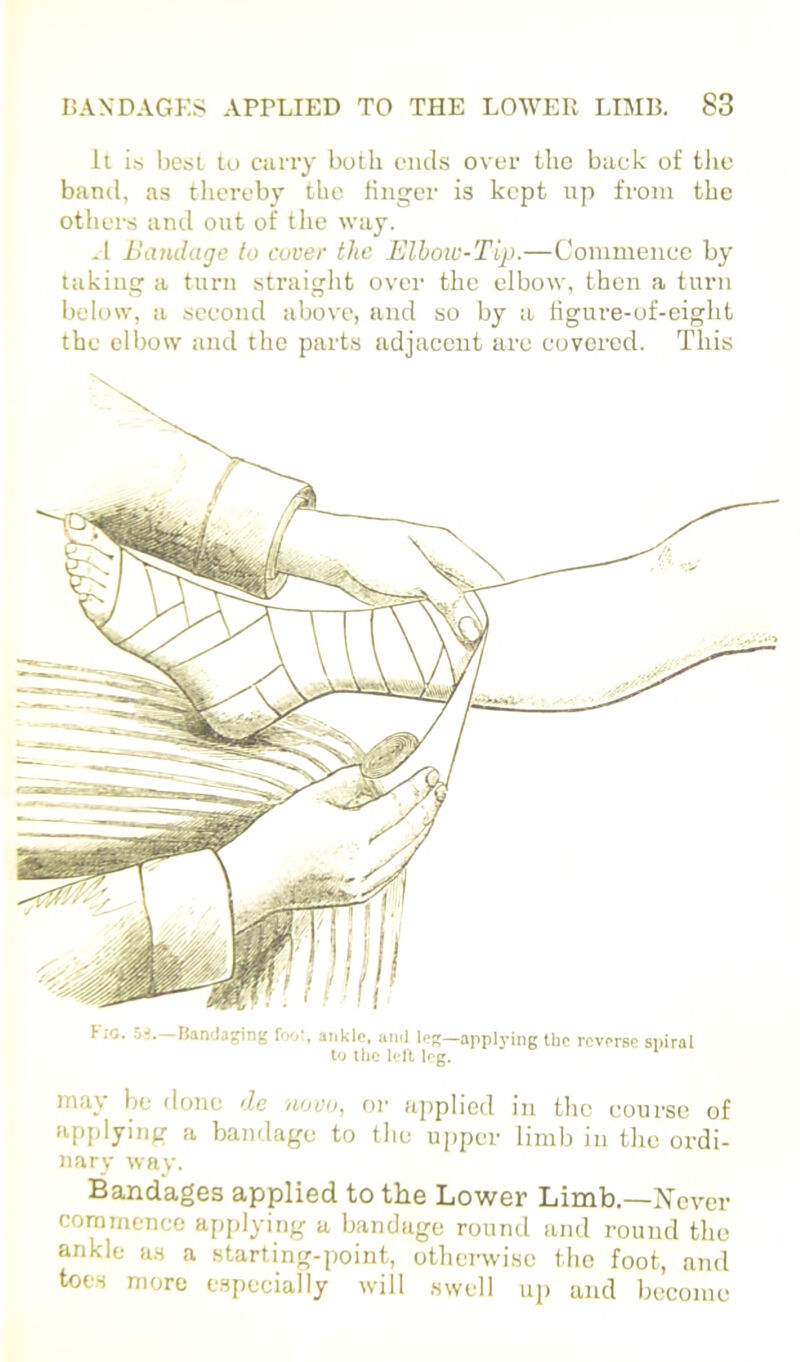 It is Ijesl to ciiny both ends over the back of tlie band, as thereby the finger is kept np from the others and out of the way. .1 Bamlaje to cover the Elhow-Tip.—Commence by taking a turn straight over the elbow, then a turn I)clow, a second iibove, and so by a figure-of-eight the elbow and the parts adjacent arc covered. This t IG. Si.—ItanJaging fool, aiiklo, ami leg—applying the reverse spiral to I he l(*ll leg. may be done de novo, or applied in the course of applying a bandage to tlic upper liml) in tlic ordi- nary way. Bandages applied to the Lower Limb.—Never commence applying a bandage round and round the ankle as a starting-point, otherwise the foot, and toes more especially will swell up and become