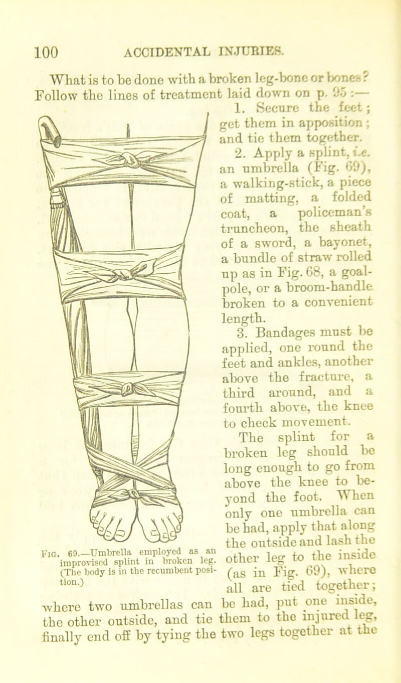 What is to be done with a broken leg-bone or bones? Follow the lines of treatment laid down on p. Oo:— 1. Secure the feet; get them in apposition ; and tie them together. 2. Apply a splint, i.e. an umbrella (Fig- 69), a walking-stick, a piece of noatting, a folded coat, a policeman’s truncheon, the sheath of a sword, a bayonet, a bundle of straw rolled up as in Fig. 68, a goal- pole, or a broom-handle broken to a convenient length. 3. Bandages must be applied, one round the feet and ankles, another above the fractm-e, a third ai-ound, and a fourth above, the knee to check movement. The splint for a broken leg should be long enough to go from above the knee to be- yond the foot. TVlien only one umbrella can be had, apply that along the outside and lash the improvised splint in broken leg. other leg tO tbC inSlQC (The body is in the recumbent posi- jjj (^9)^ where all are tied together; where two umbrellas can be had, put one inside, the other outside, and tie them to the injured 1^, finally end off by tying the two legs together at the