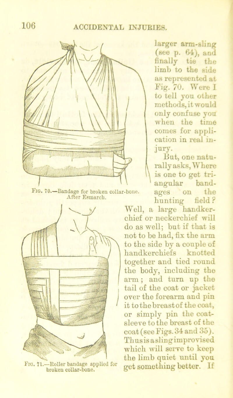 larger arm-sling (see p. M), and finally tie the limb to the side as represented at Fig. 70. Were I to tell you other methods, it would only confuse you when the time comes for appli- cation in real in- Fig. Vo.—Bandage for broken collar-bone. After Esmarcb. ]iiry. But, one natu- rally asks. Where is one to get tri- angular band- ages on the hunting field ? Well, a large handker- chief or neckerchief will do as well; but if that is not to be had, fix the arm to the side by a couple of handkerchiefs knotted together and tied i-ound the body, including the arm; and turn up the tail of the coat or jacket over the forearm and pin it to the breast of the coat, or simply pin the coatr sleeve to the breast of the coat (see Figs. 34 and 35). Thus is a sling improvised which will serve to keep the limb quiet until you get something better. If