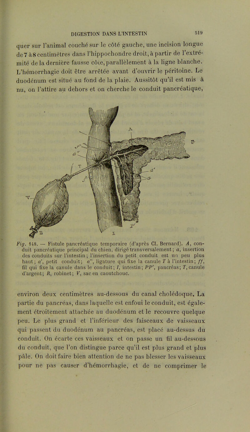 quer sur l’animal couché sur le côté gauche, une incision longue de 7 à8 centimètres dans l’hippochondre droit, à partir de l’extré- mité de la dernière fausse côie, parallèlement à la ligne blanche. L’hémorrhagie doit être arrêtée avant d’ouvrir le péritoine. Le duodénum est situé au fond de la plaie. Aussitôt qu’il est mis à nu, on l’attire au dehors et on cherche le conduit pancréatique, Fig. 148. — Fistule pancréatique temporaire (d’après Cl. Bernard). A, con- duit pancréatique principal du chien, dirigé transversalement ; a, insertion des conduits sur l’intestin ; l’insertion du petit conduit est un peu plus haut; a', petit conduit; a”, ligature qui fixe la canule T à l’intestin; ff, fil qui fixe la canule dans le conduit; /, intestin; PP’, pancréas; T, canule d’argent; R, robinet; V, sac en caoutchouc. environ deux centimètres au-dessous du canal cholédoque. La partie du pancréas, dans laquelle est enfoui le conduit, est égale- ment étroitement attachée au duodénum et le recouvre quelque peu. Le plus grand et l’inférieur des faisceaux de vaisseaux qui passent du duodénum au pancréas, est placé au-dessus du conduit. On écarte ces vaisseaux et on passe un fil au-dessous du conduit, que l’on distingue parce qu’il est plus grand et plus pâle. On doit faire bien attention de ne pas blesser les vaisseaux pour ne pas causer d’hémorrhagie, et de ne comprimer le