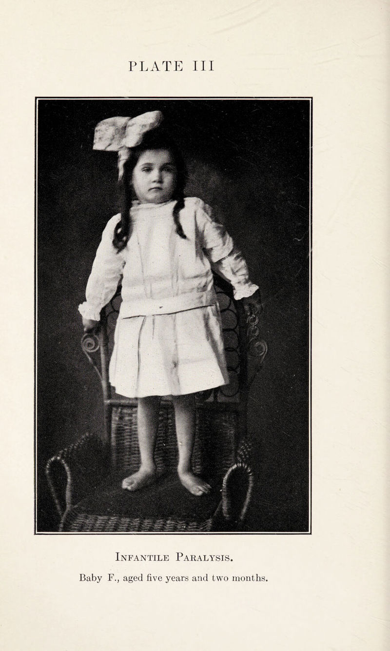 Infantile Paralysis. Baby F., aged five years and two months