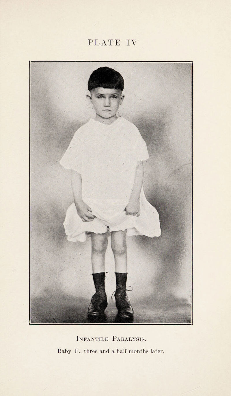 .■ ■ ■ mM-r - 11111 m 1 \ H Infantile Paralysis. Baby F., three and a half months later