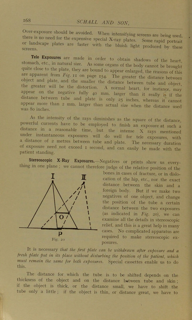 Over-exposure should be avoided. When intensifying screens are being used the e is no need for the expensive special X-ray plates. Some rapid port S screens ^ -%“h “'e «ht educed by these Tele Exposures are made in order to obtain shadows of the heart s oniach, etc. m natural size. As some organs of the body cannot be brought q ite close to the plate, they are bound to appear enlarged, the reasons of this are apparent from F,g. n on page 154. The greater the distance between object and plate, and the smaller the distance between tube and object the greater will be the distortion. A normal heart, for instance, may appear on the negative fully 40 mm. larger than it really is if the distance between tube and plate is only 25 inches, whereas it cannot appear more than 2 mm. larger than actual size when the distance used was 80 inches. As the intensity of the rays diminishes as the square of the distance powerful currents have to be employed to finish an exposure at such a distance in a reasonable time, but the intense X rays mentioned under instantaneous exposures will do well for tele exposures, with a distance of 2 metres between tube and plate. The necessary duration of exposure need not exceed 1 second, and can easily be made with the patient standing. Stereoscopic X-Ray Exposures.—Negatives or prints show us every- thing in one plane ; we cannot therefore judge of the relative position of the bones in cases of fracture, or in dislo- cation of the hip, etc., nor the exact distance between the skin and a foreign body. But if we make two negatives of one object, and change the position of the tube a certain distance between the two exposures (as indicated in Fig. 20), we can examine all the details in stereoscopic relief, and this is a great help in many cases. No complicated apparatus are required to make stereoscopic ex- posures. it is necessary that the first plate can be withdrawn after exposure and a fresh plate put in its place without disturbing the position of the patient, which must remain the same for both exposures. Special cassettes enable us to do this. The distance for which the tube is to be shifted depends on the thickness of the object and on the distance between tube and skin; if the object is thick, or the distance small, we have to shift the tube only a little ; if the object is thin, or distance great, we have to jr
