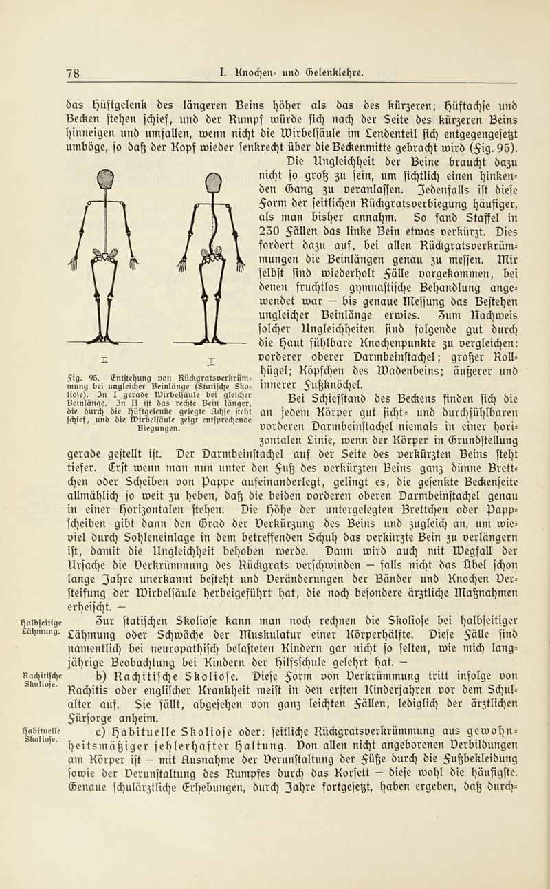 Fjalbfettige Cäfymung. Rad)itifd)e Skoliofe. habituelle Skoliofe. * I ifig. 95. (Entftefyung oon Rückgratsöerkrüm- mung bei ungleicher Beinlänge (Stative Sko= liofe). 3n I geraöe IDirbelfäuIe bei gleicher Beinlänge. 3n II ift bas rechte Bein länger, öie öurd) bie ffüftgelenke gelegte flcfyfe ftefyt fd}ief, unb bie IDirbelfäuIe 3eigt entfprecfyenöe Biegungen. bas Hüftgelenk bes längeren Beins l)öt)er als bas bes kür3eren; Hüftadjfe unb Bedien fielen fd)ief, unb ber Kumpf mürbe fid) nad) ber Seite bes kü^eren Beins t)imteigen unb Umfallen, menn nid)t bie XDirbelfäule im £enbenteil fid) entgegengefet^t umböge, jo baf$ ber Kopf mieber jenkred)t über bie Bedienmitte gebracht mirb (5ig. 95). Die Ungleichheit ber Beine braucht ba3U nid)t jo groft 3U (ein, um fid)tlid) einen hia^1 ben (Bang 3U oeranlaffen. 3ebenfalls ift bieje 5orm ber jeitlidjen Kückgratsoerbiegung häufiger, als man bisher annahm. So fanb Staffel in 230 $ällen 5a$ ün^e Bein etmas oerkür3t. Dies forbert ba3u auf, bei allen Kückgratsoerkrüm= mutigen bie Beinlängen genau 3U meffen. IKir jelbft finb mieberholt 5älle oorgekommen, bei benen fruchtlos gpmnaftijdje Behanblung ange= menbet mar - bis genaue KTejfung bas Beftehen ungleid)er Beinlänge ermies. 3um Uadjmeis fo!cf)er Ungleichheiten finb folgenbe gut burd) bie Haut fühlbare Knod)enpunkte 3U Dergleichen: Dorberer oberer Darmbeinftad)el; großer Kolb hügel; Köpfchen bes töabenbeins; äußerer unb innerer 5u&knöd)el. Bei Sd)iefftanb bes Bediens finben fid) bie an jebem Körper gut fid)t= unb burd)füt)tbaren oorberen Darmbeinftad)el niemals in einer f)oti= 3ontalen £inie, menn ber Körper in (Brunbftellung gerabe geftellt ift. Der Darmbeinftad)el auf ber Seite bes oerkü^ten Beins fteht tiefer. (Erft menn man nun unter ben bes Derkiir3ten Beins gan3 bünne Bretb d)en ober Sd)eiben oon Pappe aufeinanberlegt, gelingt es, bie gefenkte Bedienfeite allmählid) fo meit 3U h^äen, baf$ bie beiben oorberen oberen Darmbeinftad)el genau in einer HorBon^aien ftcf)en. Die H°he bet untergelegten Brettd)en ober Papp= fd)eiben gibt bann ben (Brab ber Derkür3ung bes Beins unb 3ugleid) an, um mie= oiel burd) Sohleneinlage in bem betreffenben $d)uh bas oerkür3te Bein 3U oerlängern ift, bamit bie Ungleichheit behoben merbe. Dann mirb aud) mit IDegfaU ber Urfadje bie Derkrümmung bes Küdigrats oerfd)minben - falls nid)t bas Übel fd)on lange 3ohre unerkannt beftet)t unb Deränberungen ber Bänber unb Knochen Der= fteifung ber XDirbelfäule herbeigeführt hat, bie nod) befotibere är3tlid)e HTafonahmen erheifd)t. - 3ur ftatifd)en Skoliofe kann man nod) rechnen bie Skoliofe bei halbfeitiger £ähmung ober Sd)mäd)e ber ITTuskulatur einer Körperhälfte. Diefe $älle finb namentlich bei neuropathifd) belafteten Kinberrt gar nid)t fo feiten, mie mid) lang= jährige Beobachtung bei Kinbern ber J^ilfsfcHule gelehrt hat. - b) Kad)itifd)e Skoliofe. Diefe 5°rm üon Derkrümmung tritt infolge oon Kad)itis ober englifd)er Krankheit meift in ben erften Kinberjat)ren oor bem Sd)ul= alter auf. Sie fällt, abgefehen oon gan3 leichten 5äUen, lebiglid) ber ältlichen 5ürforge anheim. c) Habituelle Skoliofe ober: feitlidje Küdigratsoerkrümmung aus gemol)n = heitsmäfeiger fehlerhafter Haltung. Don allen nicht angeborenen Derbilbungen am Körper ift — mit Rusnat)me ber Derunftaltung bet 5ü&e burd) bie 5u&bekleibutig jomie ber Derunftaltung bes Kumpfes burd) bas Korfett — bieje mol)l bie häufigfte. (Benaue fd)ulär3tlid)e (Erhebungen, burd) 3al)re fortgefetjt, haben ergeben, bafj burd)=