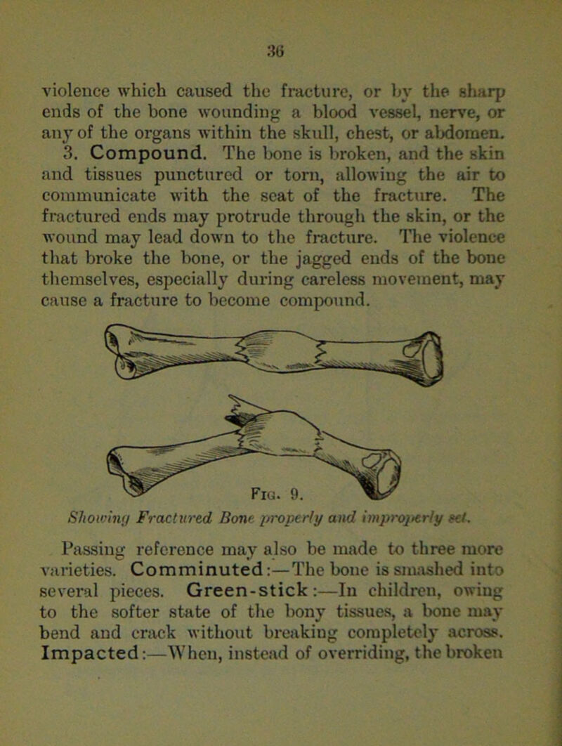 violence which caused the fracture, or by the sharp ends of the bone wounding a blood vessel, nerve, or any of the organs within the skull, chest, or abdomen. 3. Compound. The bone is broken, and the skin and tissues punctured or torn, allowing the air to communicate with the scat of the fracture. The fractured ends may protrude through the skin, or the wound may lead down to the fracture. The violence that broke the bone, or the jagged ends of the bone themselves, especially during careless movement, may cause a fracture to become compound. Showing Fractured Bone properly and improjicr/y ret. Passing reference may also be made to three more varieties. Comminuted:—The bone is smashed into several pieces. Green-stick:—In children, owing to the softer state of the bony tissues, a bone may bend and crack without breaking completely across. Impacted:—When, instead of overriding, the broken