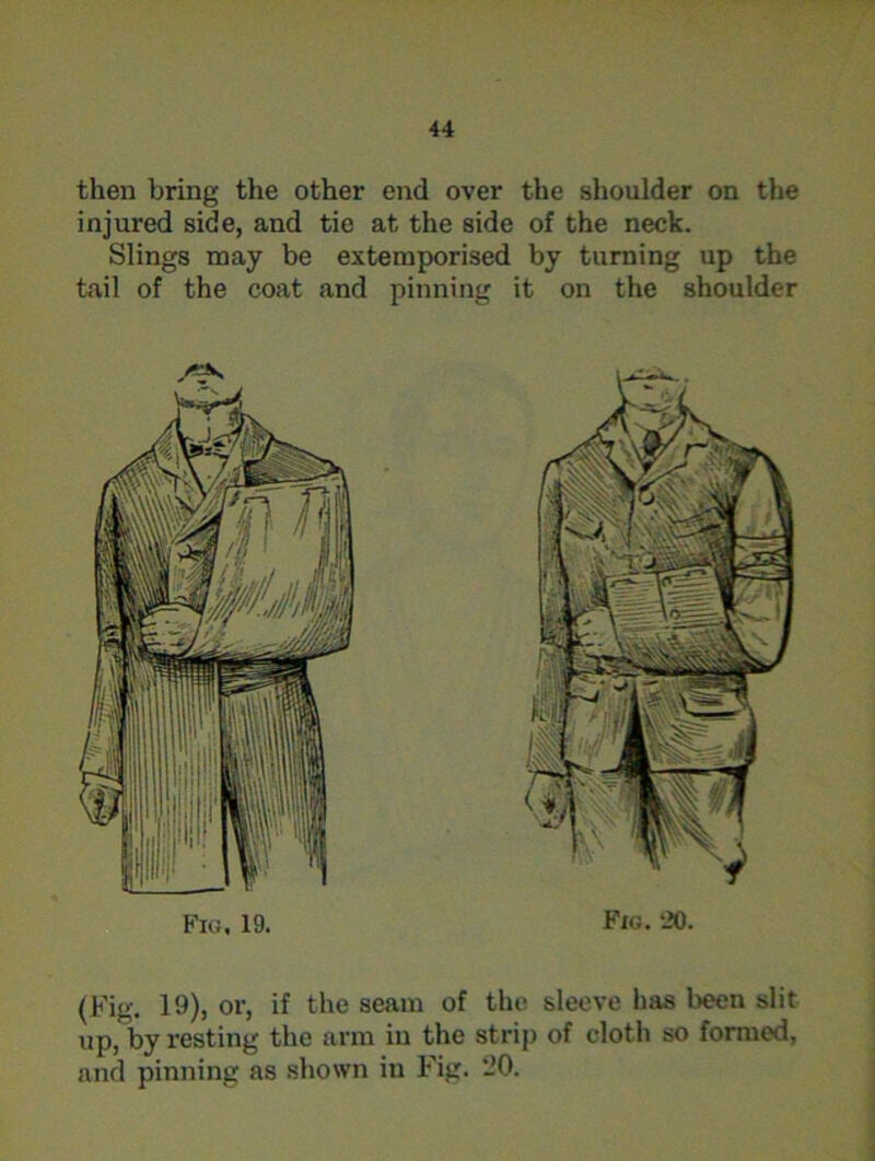 then bring the other end over the shoulder on the injured side, and tie at the side of the neck. Slings may be extemporised by turning up the tail of the coat and pinning it on the shoulder (Fig. 19), or, if the seam of the sleeve has been slit up, by resting the arm in the strip of cloth so formed, and pinning as shown in Fig. 20.