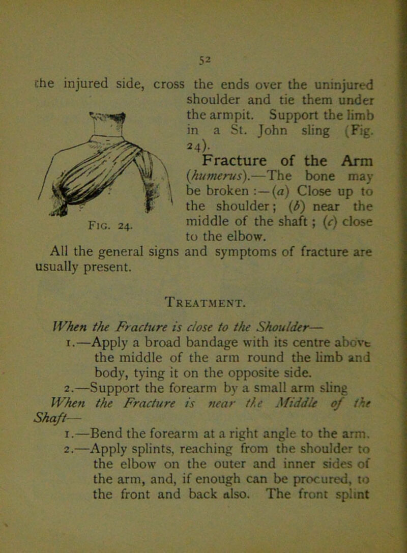 che injured side, cross the ends over the uninjured Fig. 24. All the general signs usually present. shoulder and tie them under the armpit. Support the limb in a St. John sling (Fig. 24). Fracture of the Arm {humerus).—The bone may be broken (a) Close up to the shoulder; (£) near the middle of the shaft; (c) close to the elbow. and symptoms of fracture are Treatment. When the Fracture is close to the Shouldet— 1. —Apply a broad bandage with its centre above the middle of the arm round the limb and body, tying it on the opposite side. 2. —Support the forearm by a small arm sling When the Fracture is near the A fiddle of the Shaft— 1. —Bend the forearm at a right angle to the arm. 2. —Apply splints, reaching from the shoulder to the elbow on the outer and inner sides of the arm, and, if enough can be procured, to the front and back also. The front splint